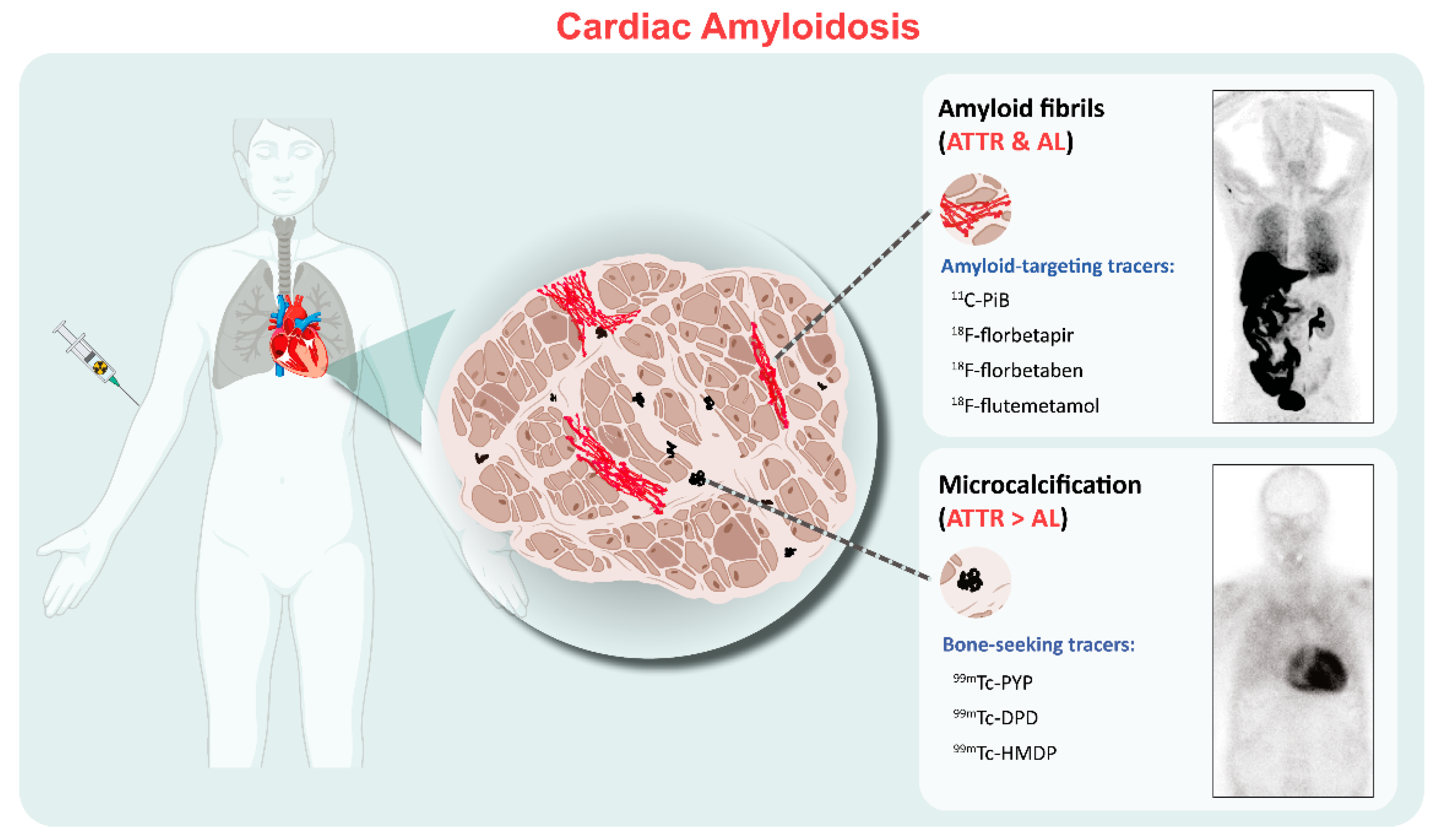 Global and Regional Variations in Transthyretin Cardiac