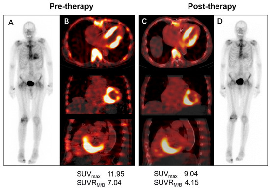 Nuclear Molecular Imaging of Disease Burden and Response to Treatment ...