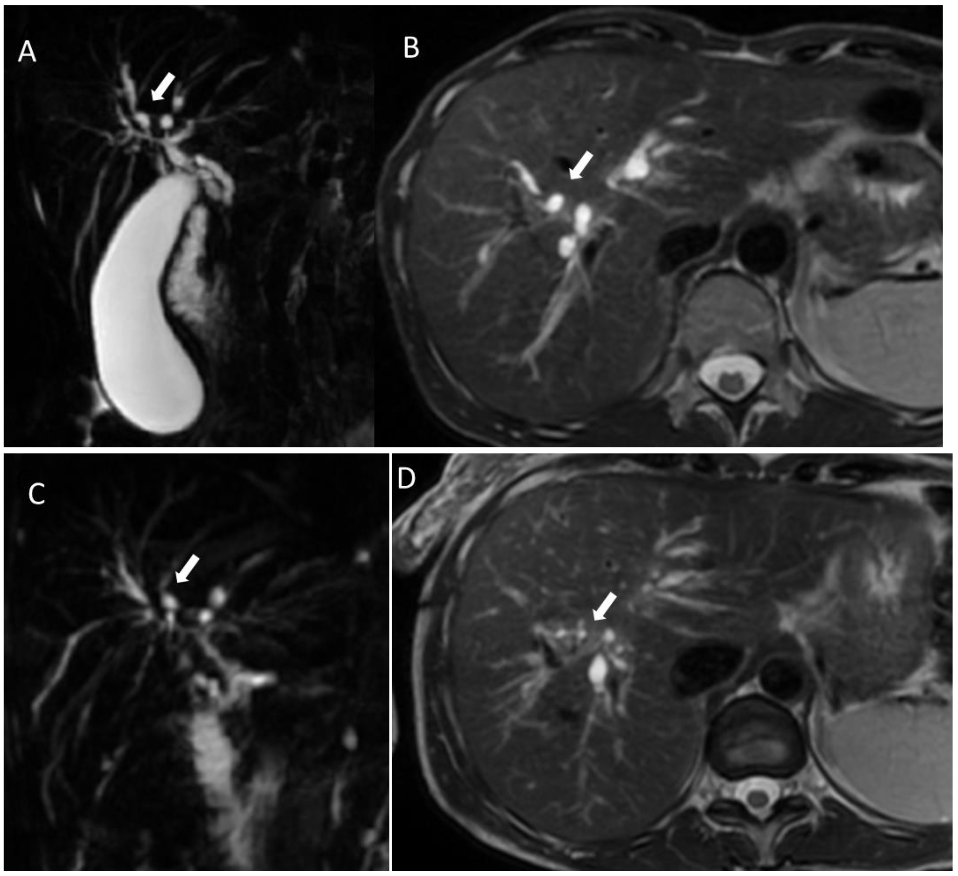 Risk Assessment and Cholangiocarcinoma: Diagnostic Management and ...