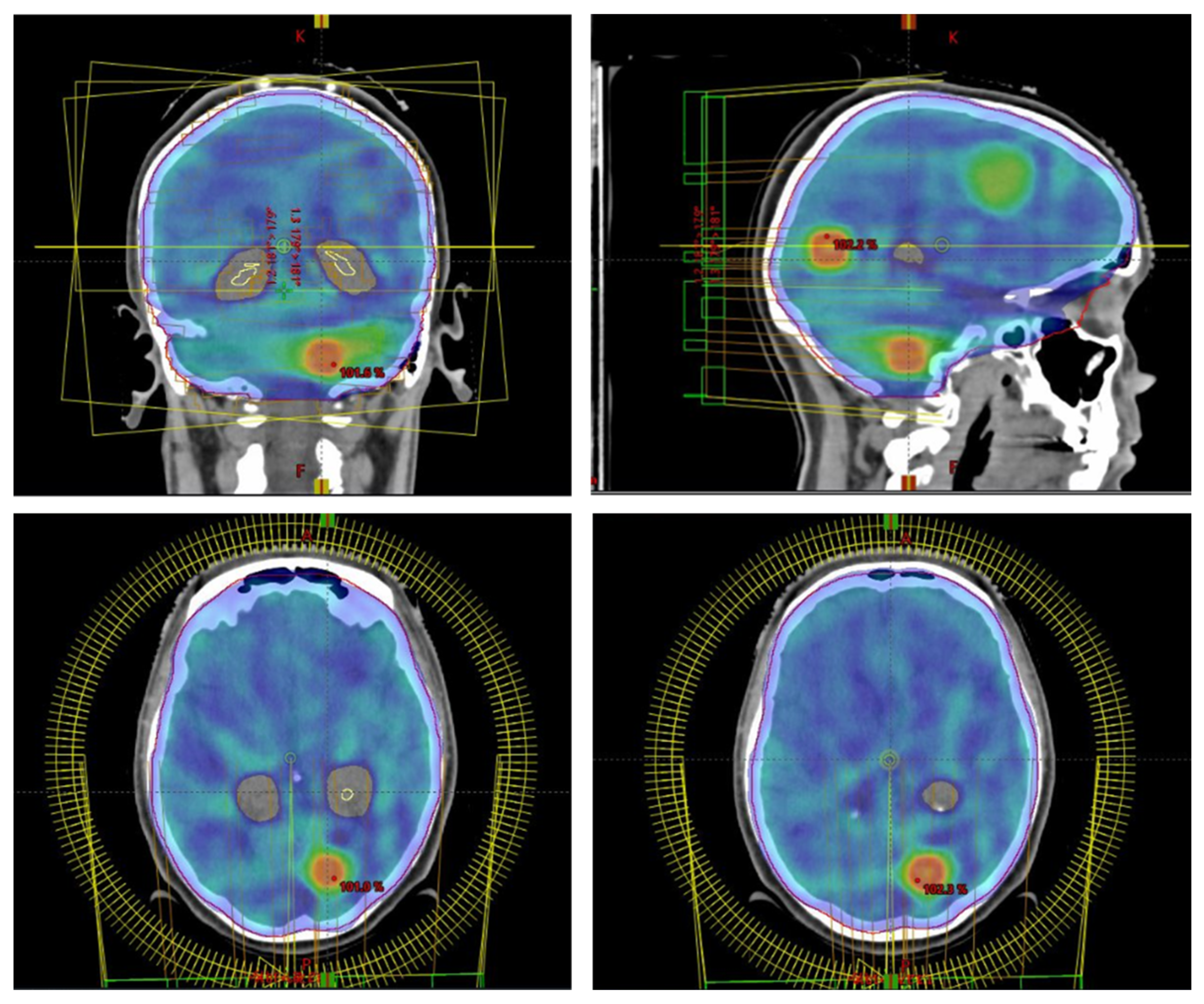 The First Survival Score for Patients Treated with Whole