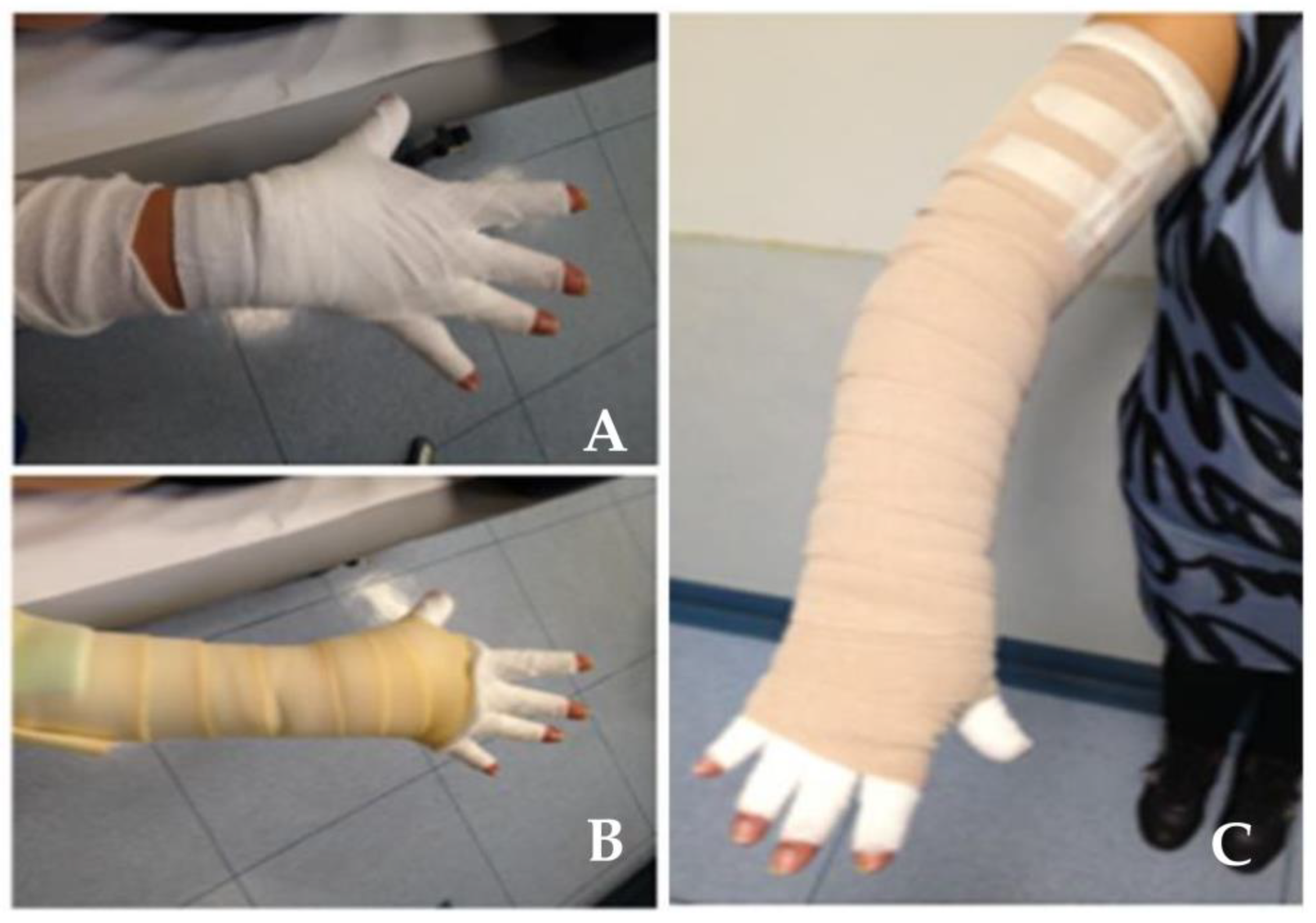 Biology Free FullText Secondary Lymphedema Clinical Interdisciplinary Tricks to