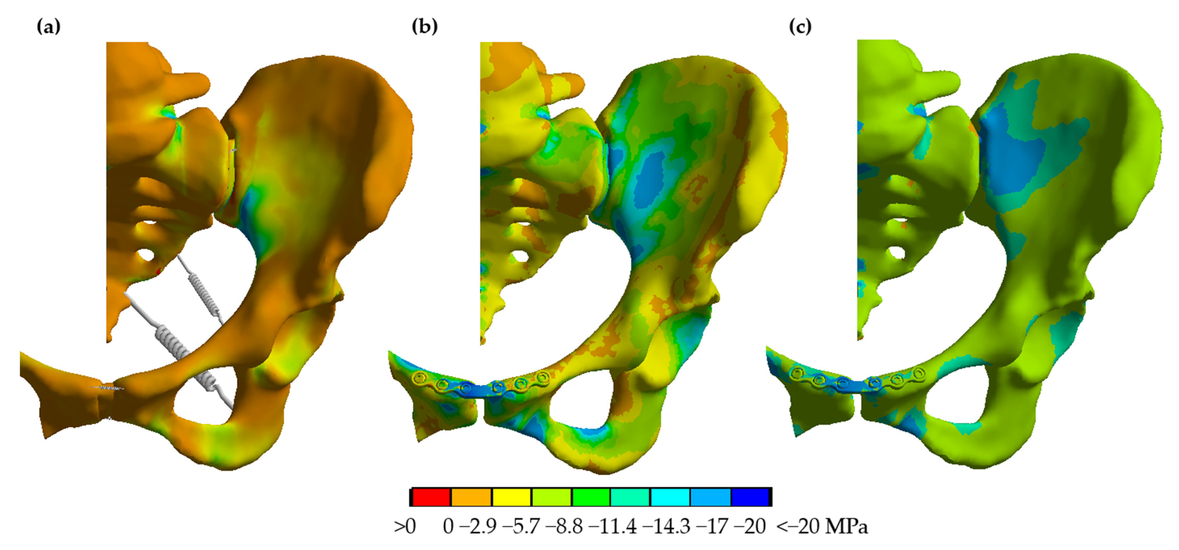 Comparative Finite Element Analysis of Fixation Techniques