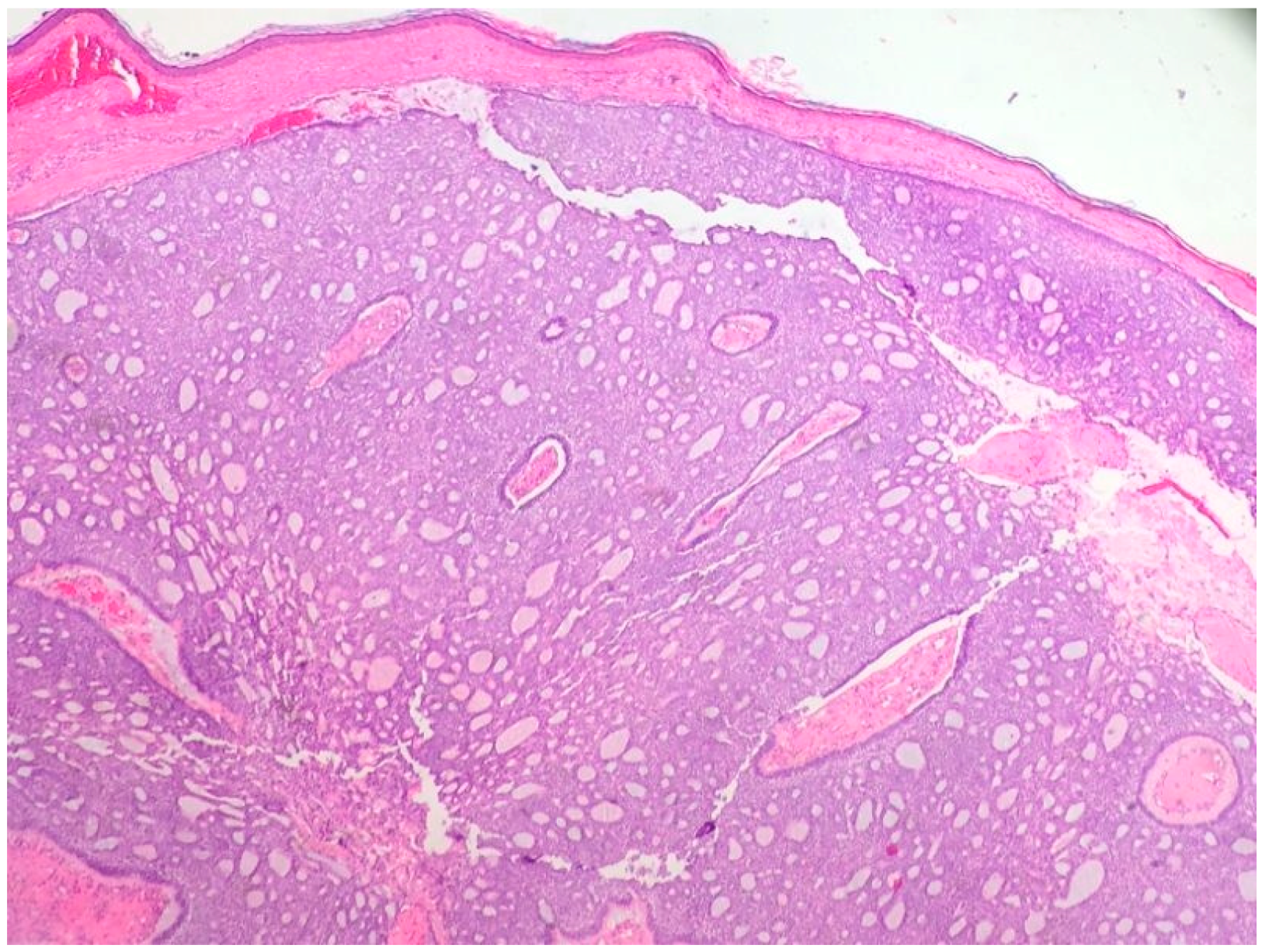 squamous cell carcinoma in situ histology