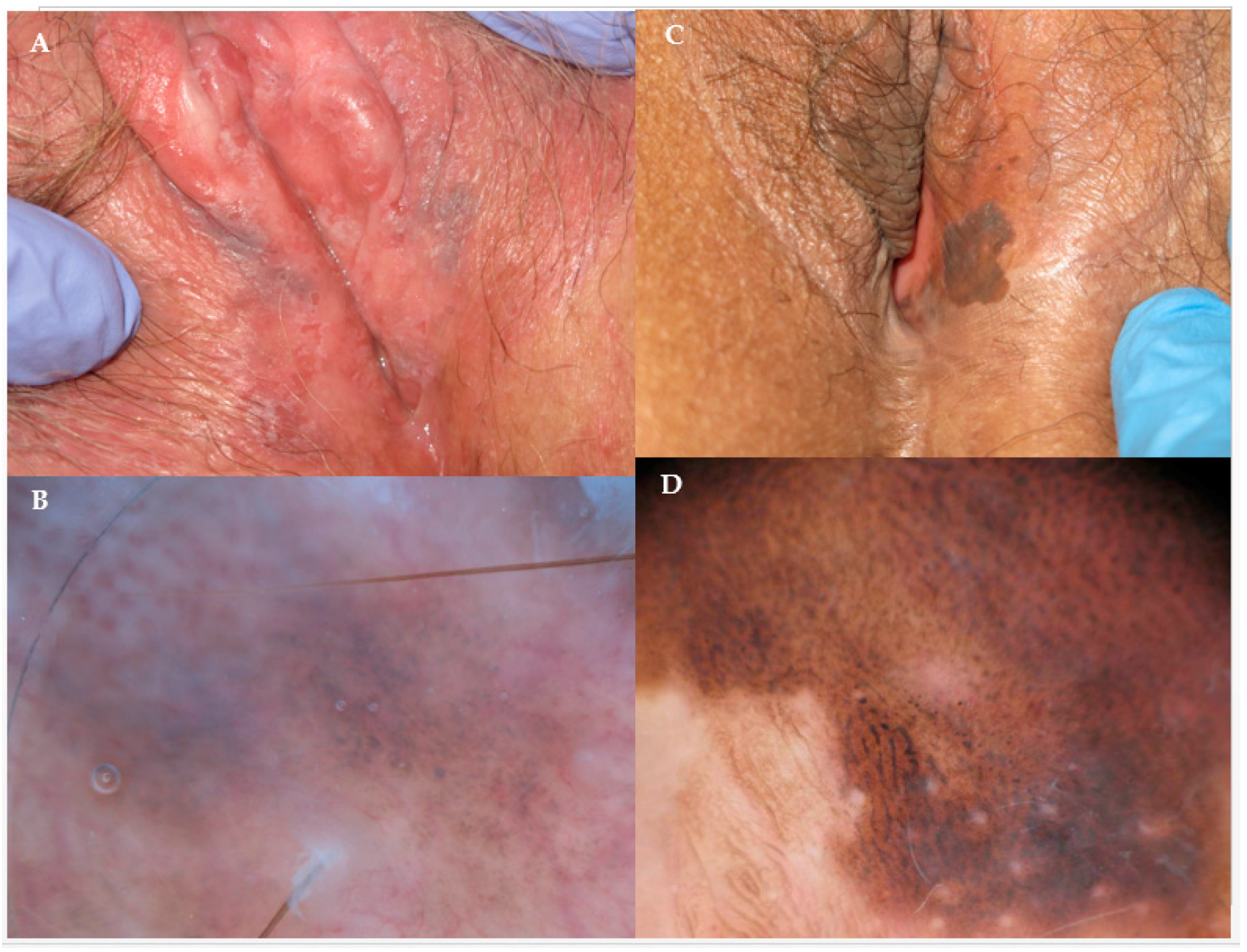 Biomedicines | Free Full-Text | The Role of Photodynamic Therapy in the  Treatment of Vulvar Intraepithelial Neoplasia