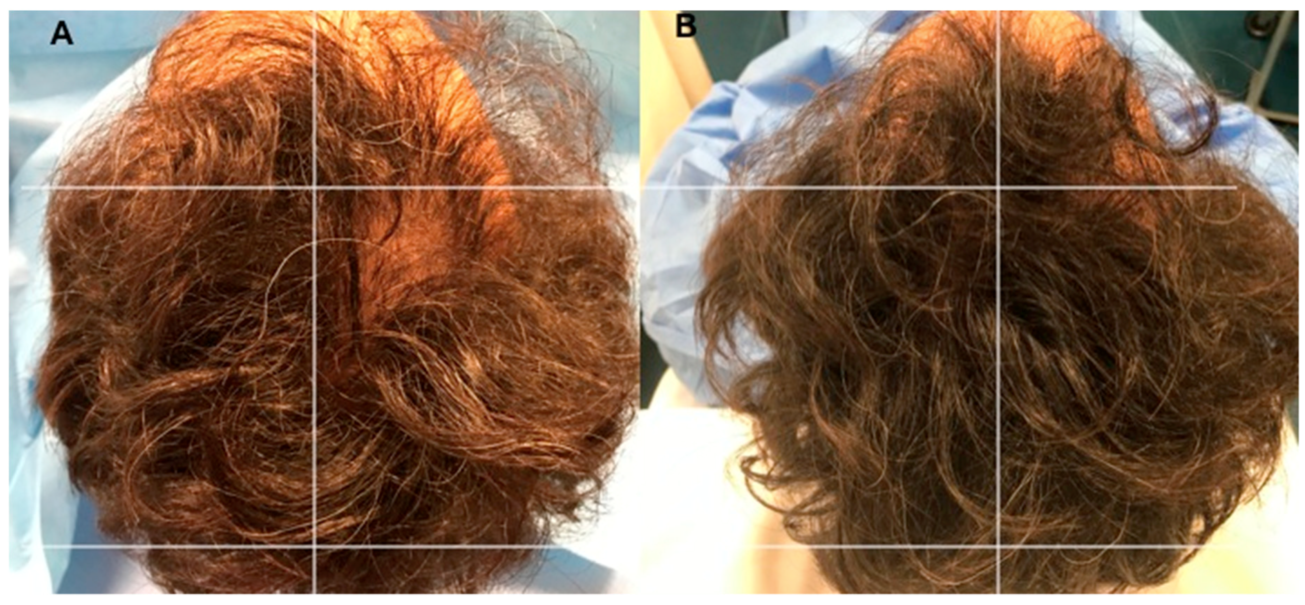 Biomedicines | Free Full-Text | Platelet-Rich Plasma and Micrografts  Enriched with Autologous Human Follicle Mesenchymal Stem Cells Improve Hair  Re-Growth in Androgenetic Alopecia. Biomolecular Pathway Analysis and  Clinical Evaluation