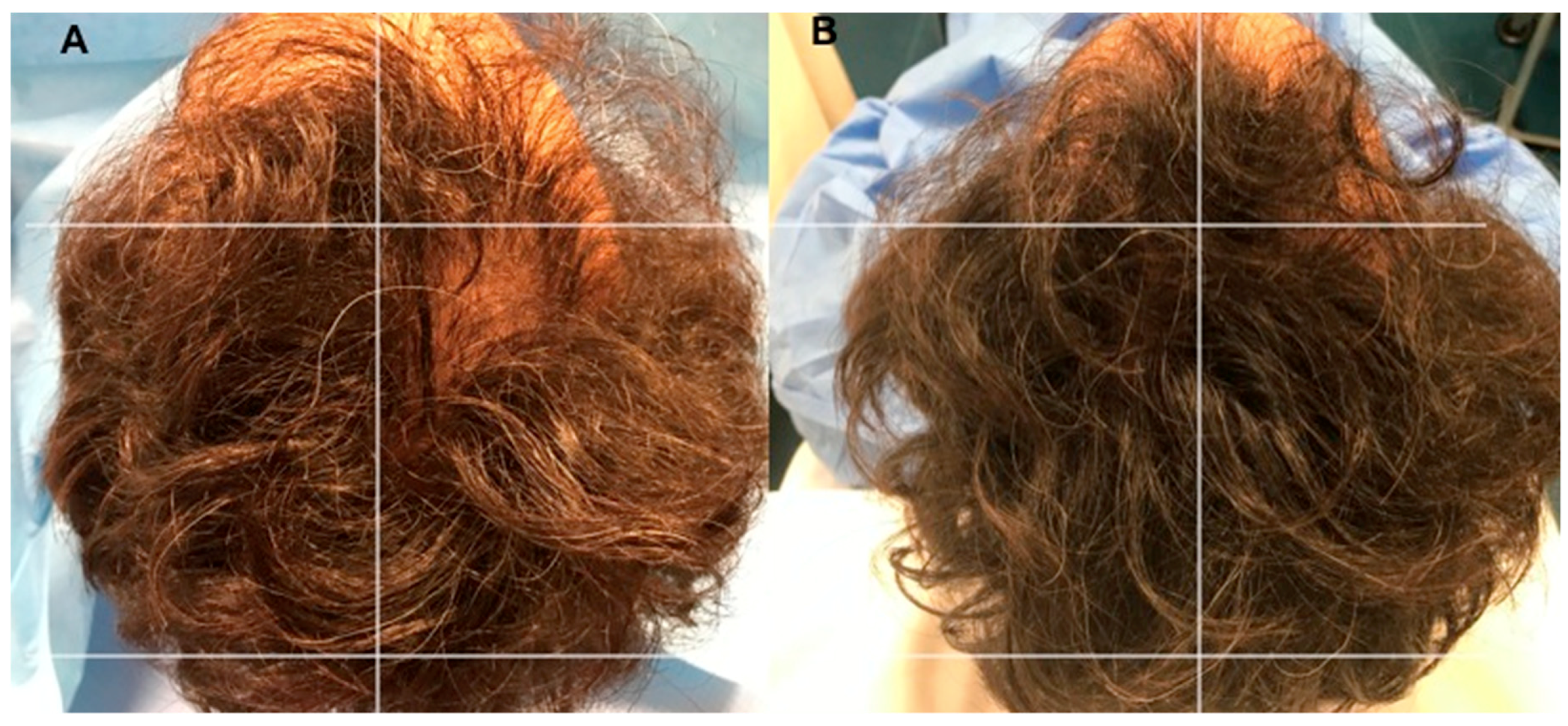 Biomedicines | Free Full-Text | Platelet-Rich Plasma and Micrografts Enriched with Autologous Human Follicle Mesenchymal Stem Cells Improve Hair Re-Growth in Androgenetic Alopecia. Biomolecular Pathway Analysis and Clinical Evaluation Biomedicines | Free Full-Text | Platelet-Rich Plasma and Micrografts Enriched with Autologous Human Follicle Mesenchymal Stem Cells Improve Hair Re-Growth in Androgenetic Alopecia. Biomolecular Pathway Analysis and Clinical Evaluation