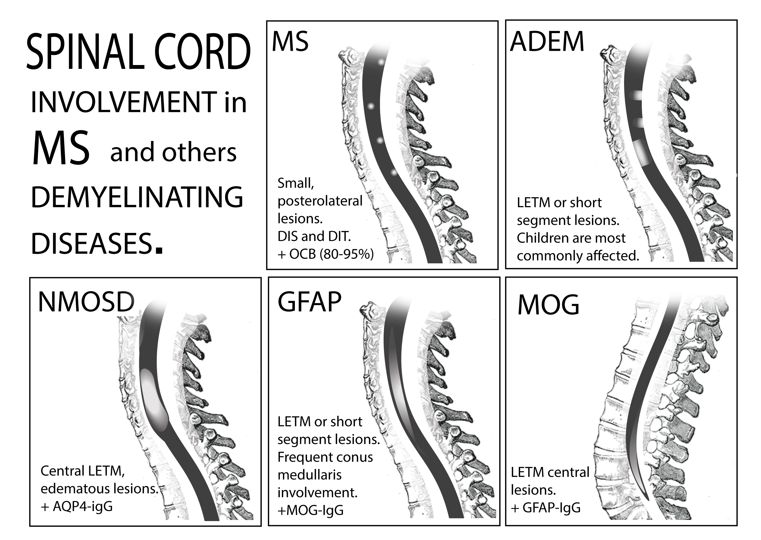 Biomedicines free full text spinal cord involvement in ms and other