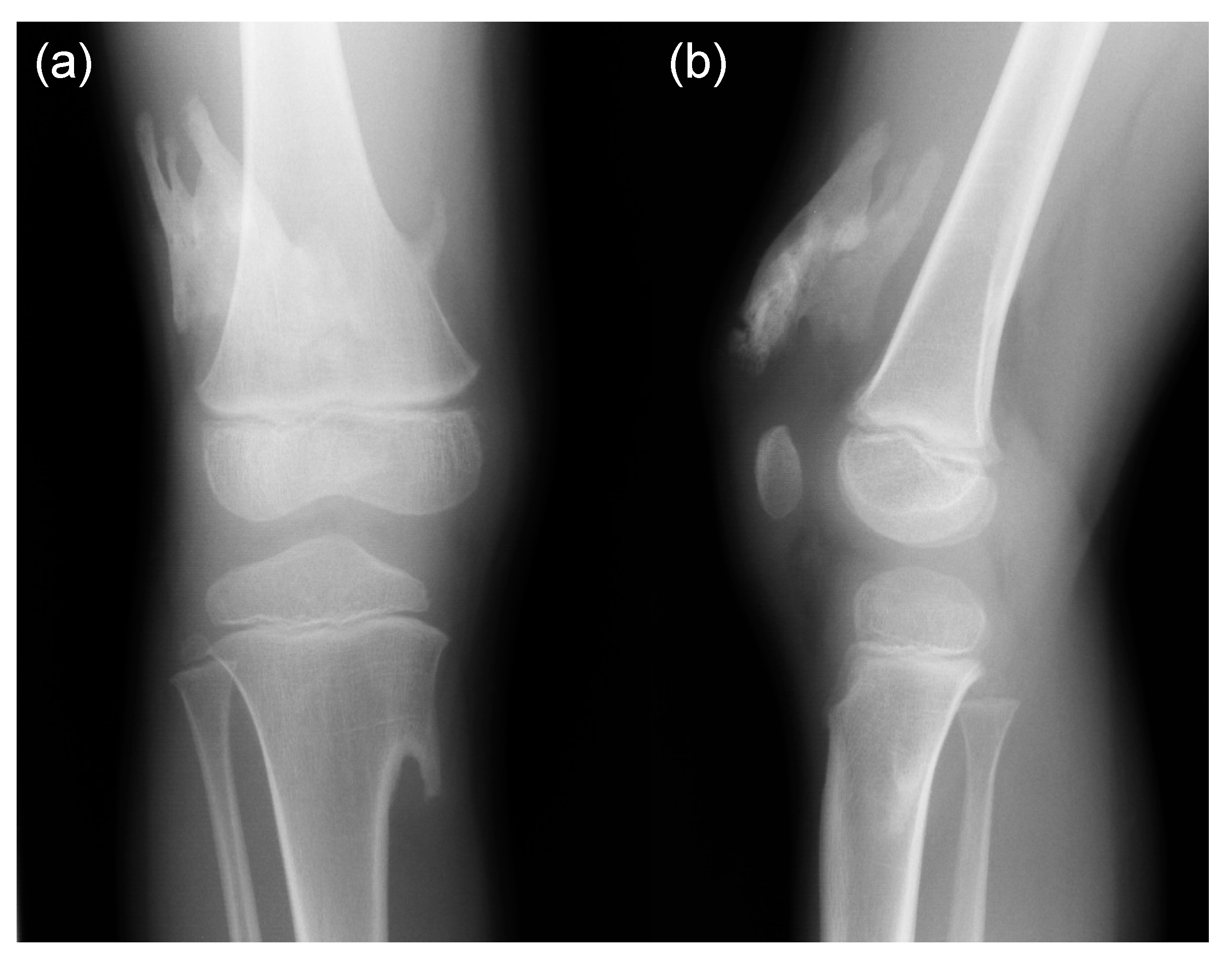 健康・医学 Occlusion Heterotopic Ossification | Musculoskeletal Key
