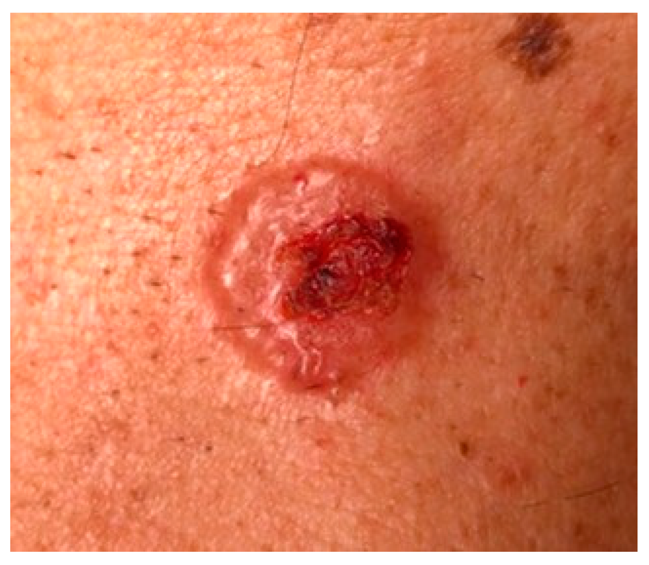 biomedicines free full text basal cell carcinoma from pathophysiology to novel therapeutic approaches html