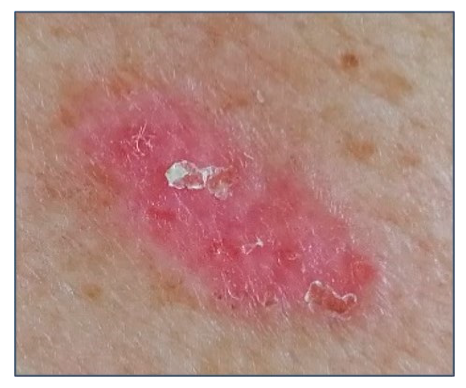 biomedicines free full text basal cell carcinoma from pathophysiology to novel therapeutic approaches html