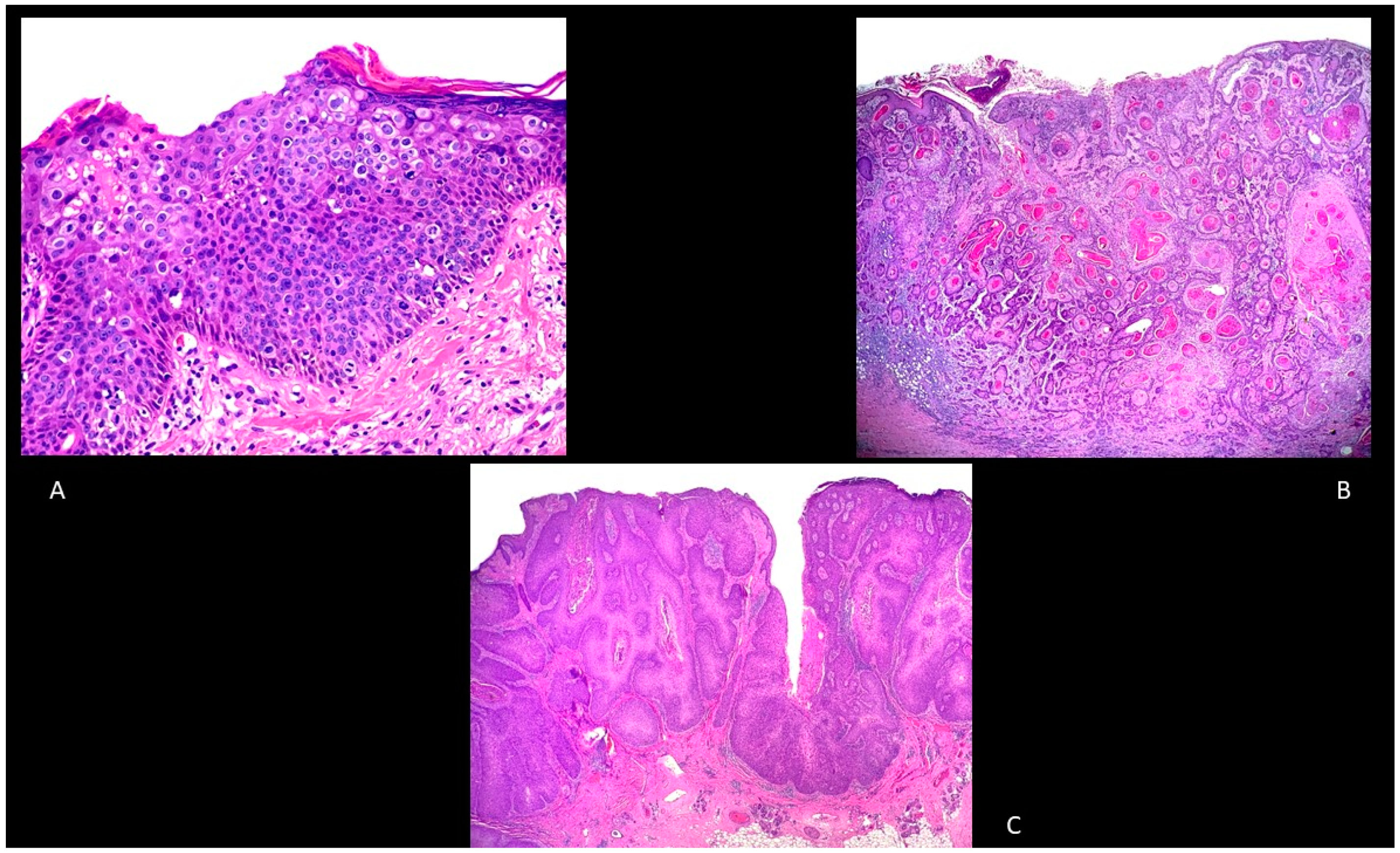 Biomedicines Free Full Text Cutaneous Squamous Cell Carcinoma From Pathophysiology To Novel Therapeutic Approaches Html