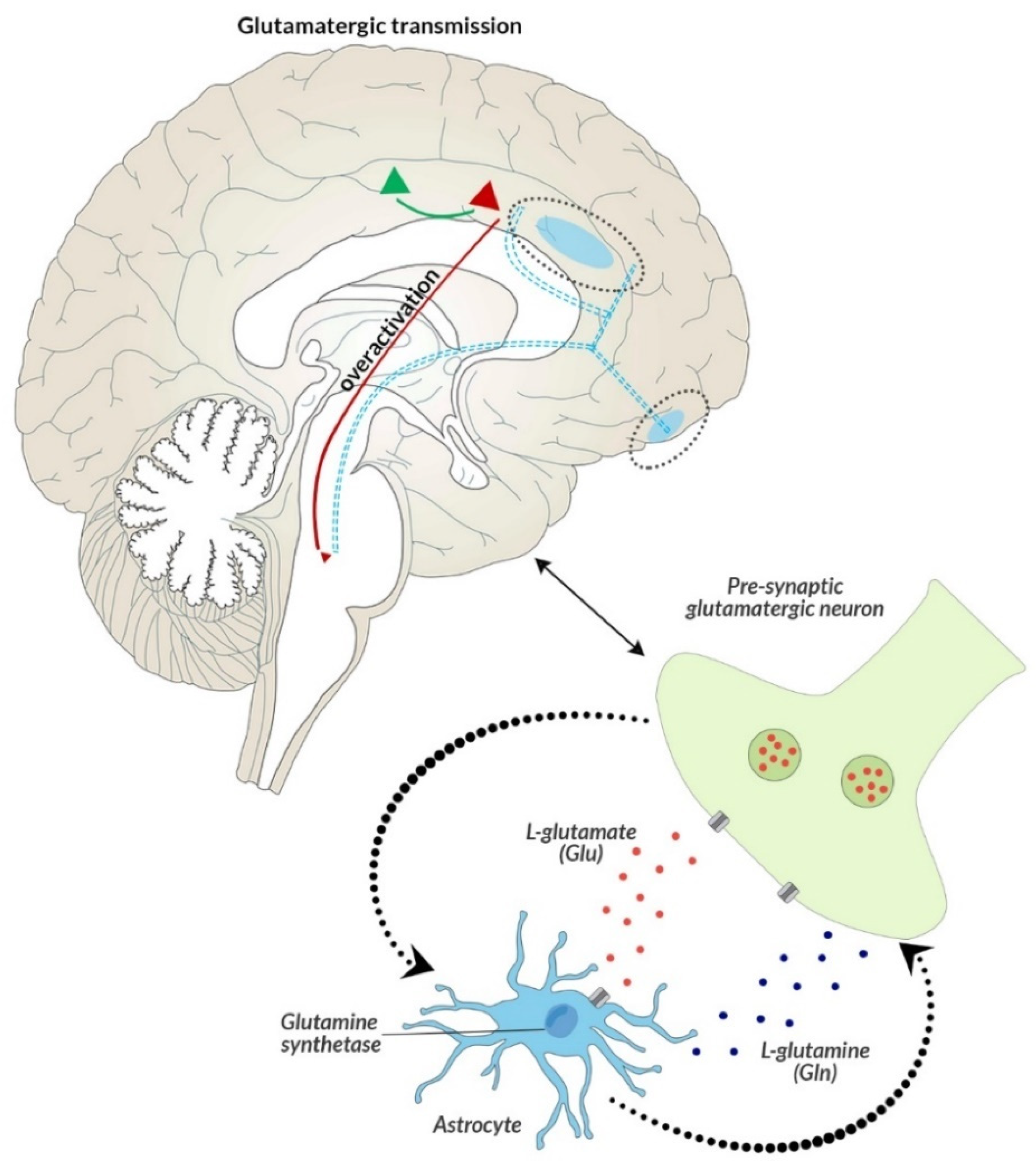 Schizophrenia Brain Ventricles