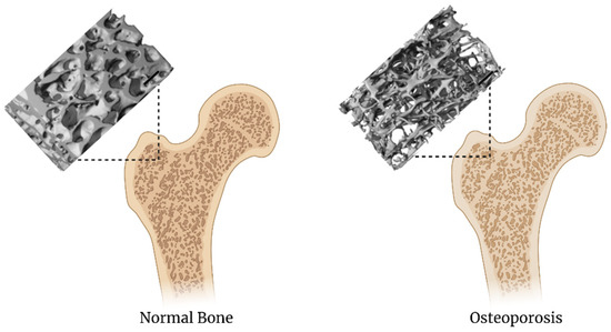 Biomedicines | Free Full-Text | Tissue Engineering Through 3D Bioprinting to Recreate and Study Bone Disease Biomedicines | Free Full-Text | Tissue Engineering Through 3D Bioprinting to Recreate and Study Bone Disease