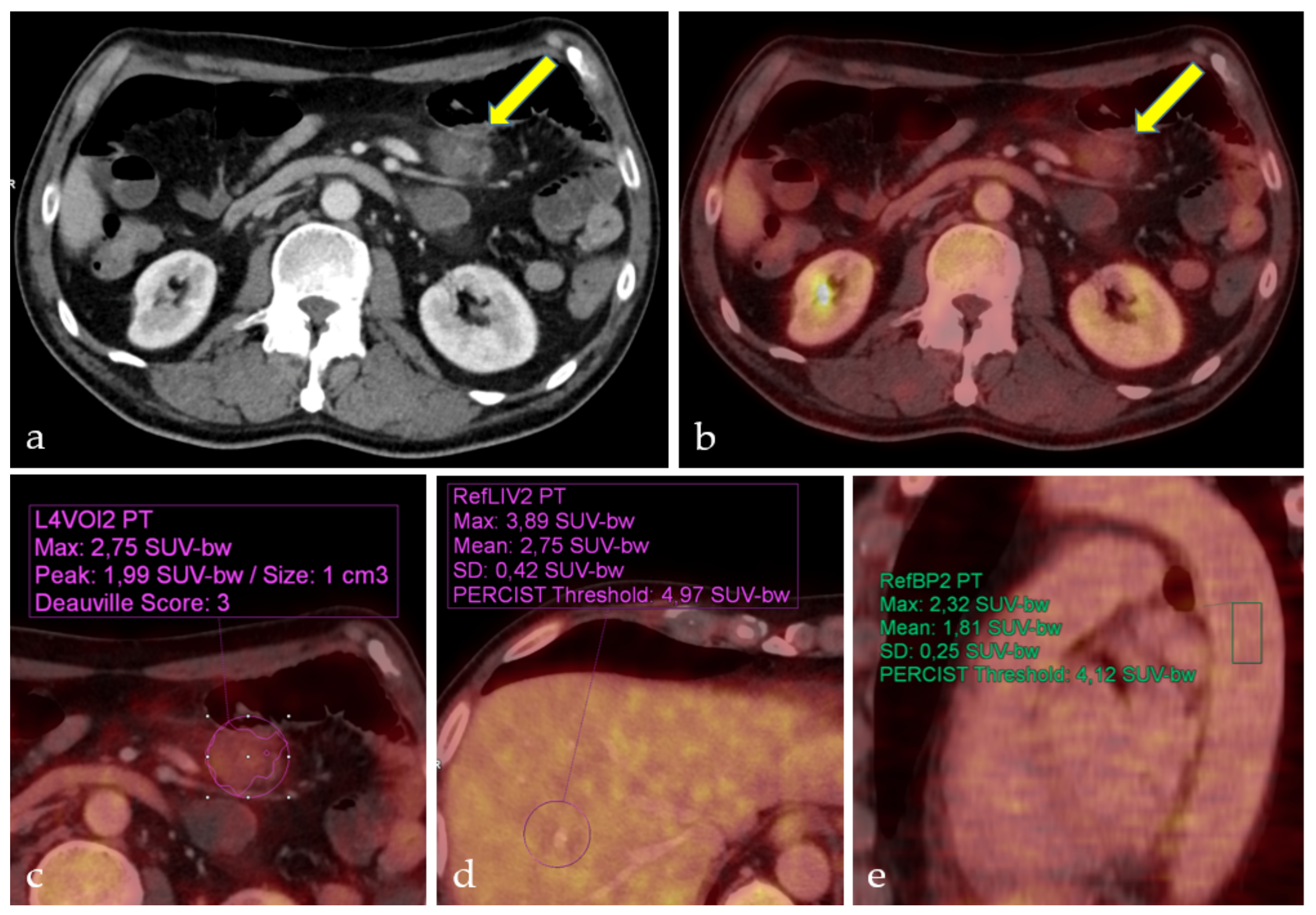 Biomedicines Free Full Text Radiotherapy In Follicular Lymphoma Staged By 18f Fdg Pet Ct A German Monocenter Study Html Biomedicines Free Full Text Radiotherapy In Follicular Lymphoma Staged By 18f Fdg Pet Ct A German Monocenter Study Html