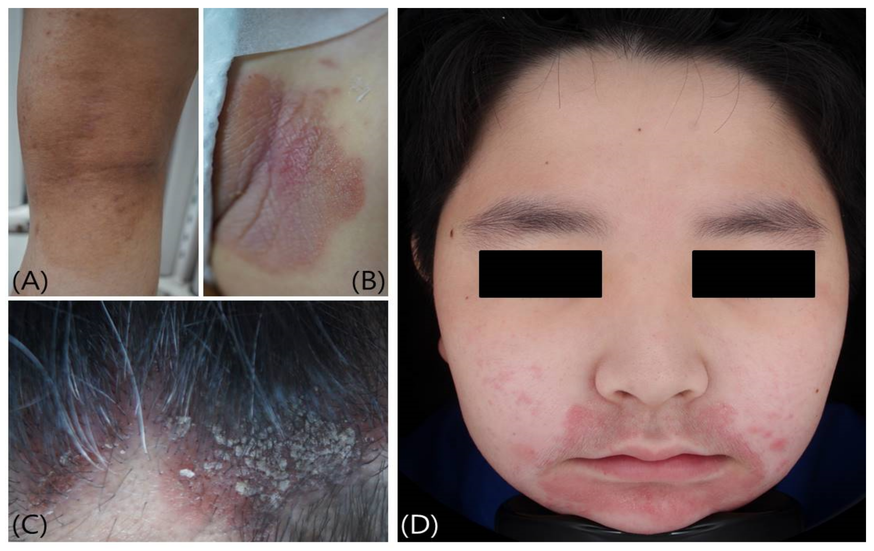 Epidemiology and extracutaneous comorbidities of severe acne in