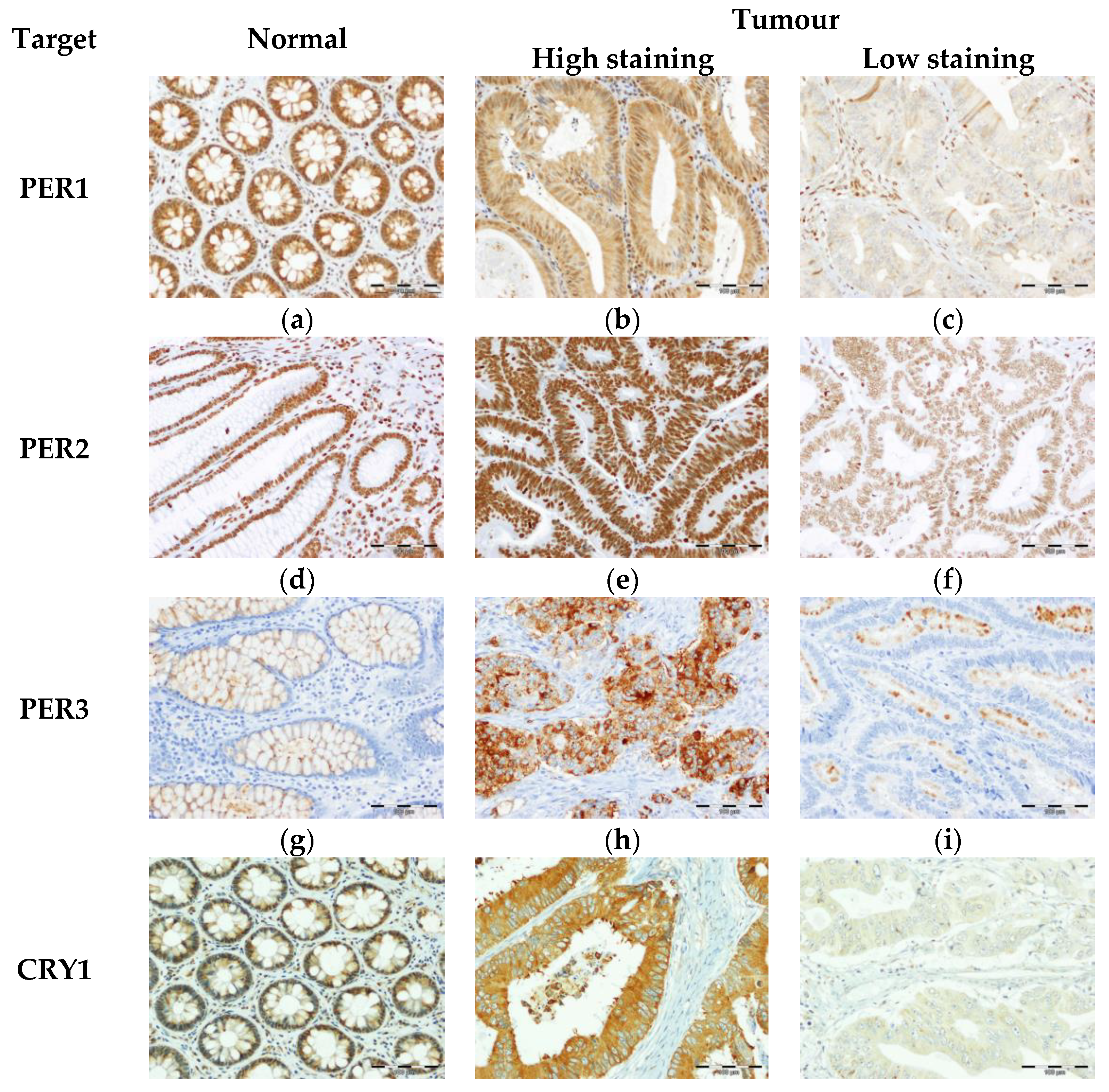 Biomedicines Free Full Text Core Circadian Clock Proteins As Biomarkers Of Progression In Colorectal Cancer