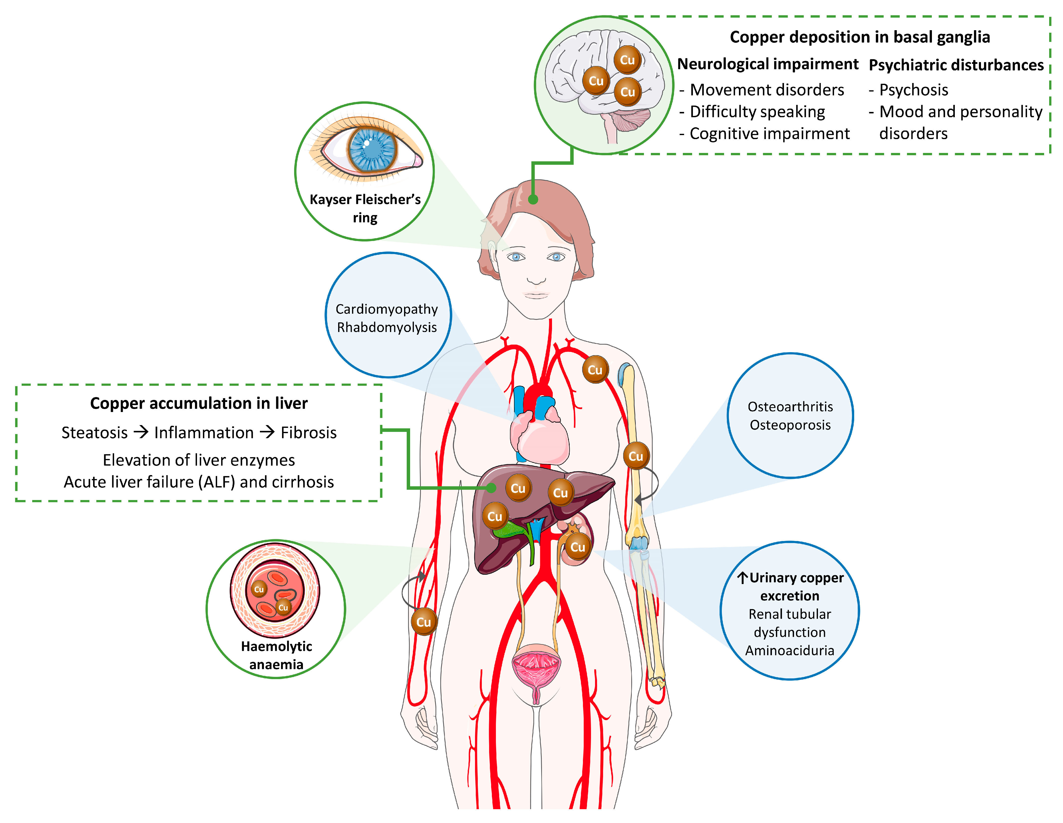 Symptoms & Causes of Wilson Disease - NIDDK