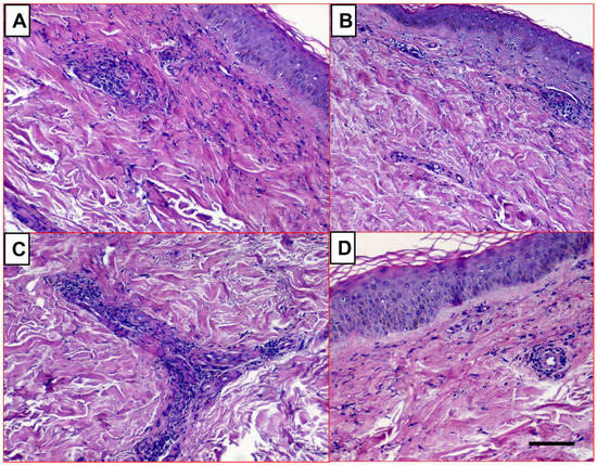 Lupus Vasculitis: An Overview Lupus Vasculitis: An Overview