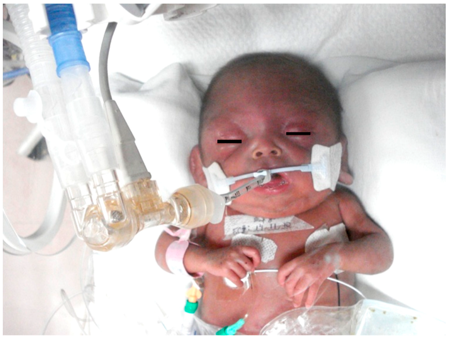 Look further into Birth Asphyxia Look further into Birth Asphyxia