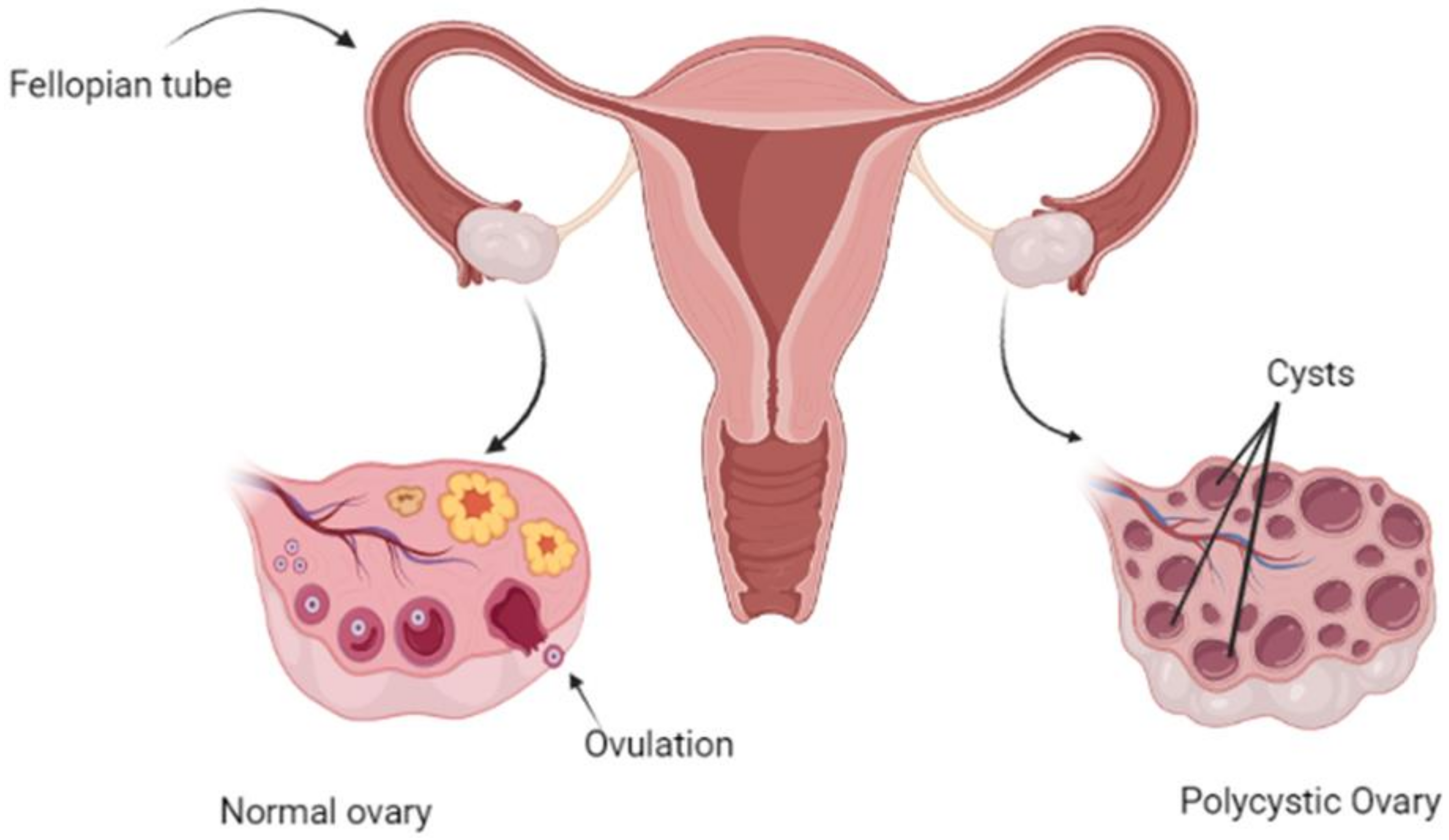 10 Symptoms of polycystic ovary syndrome (PCOS) You Should Never Ignore