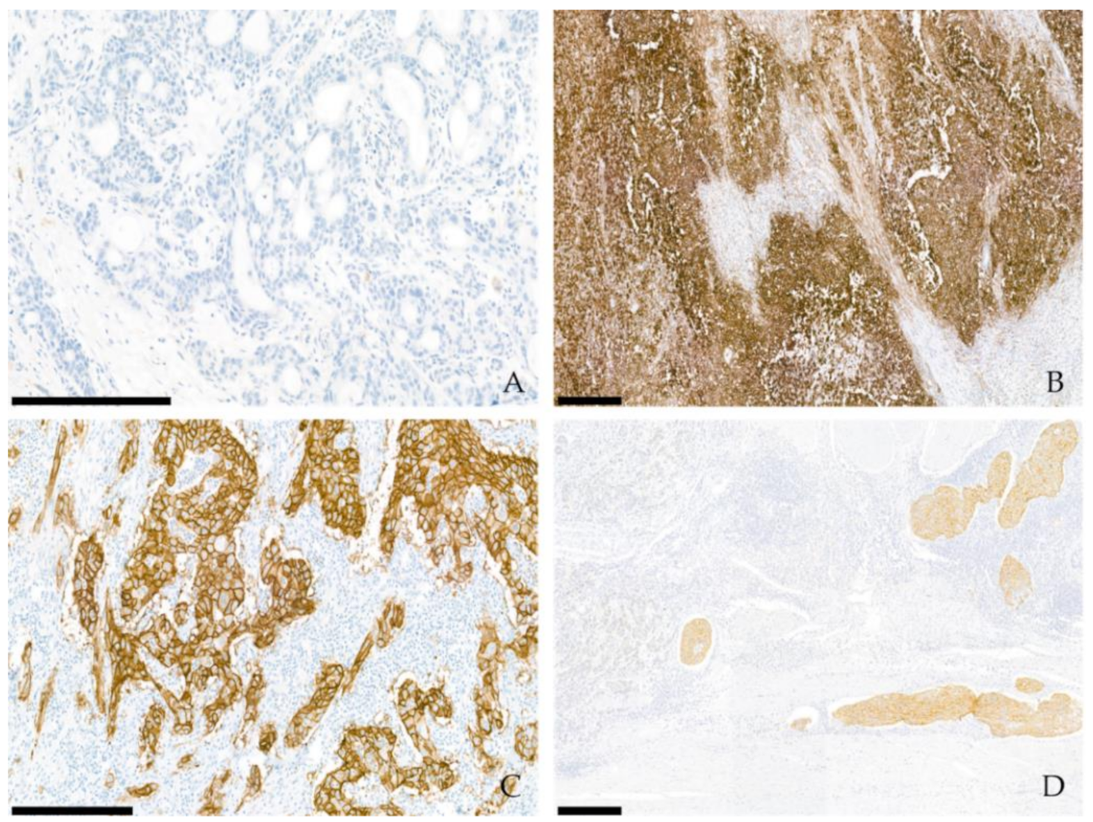 Gastric Cancer: Mechanisms, Biomarkers, and Therapeutic