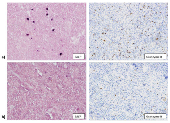 Macrophage Infiltration Correlates with Genomic Instability in
