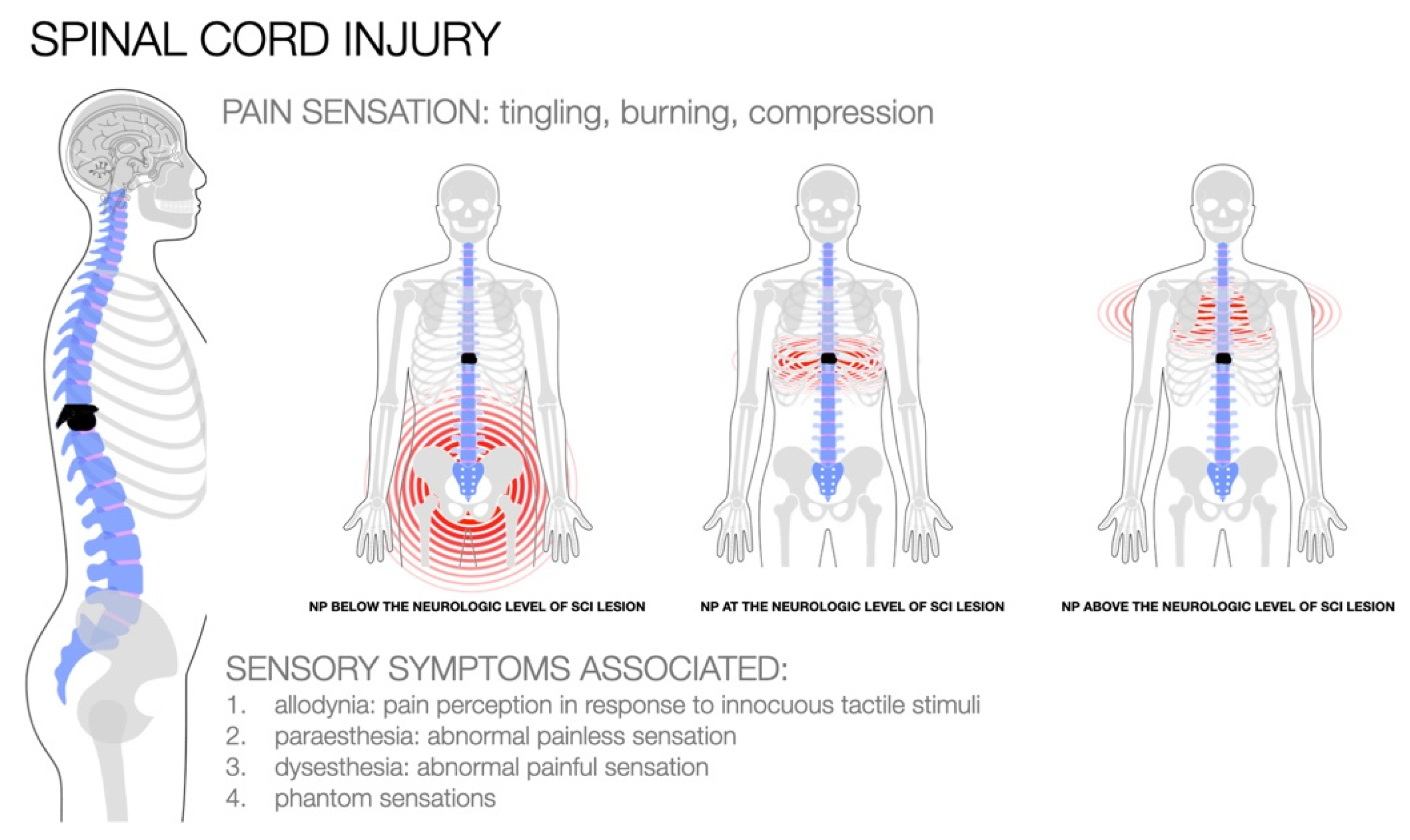 Spinal Cord Stimulator: Uses, Benefits, Side Effects, Precautions