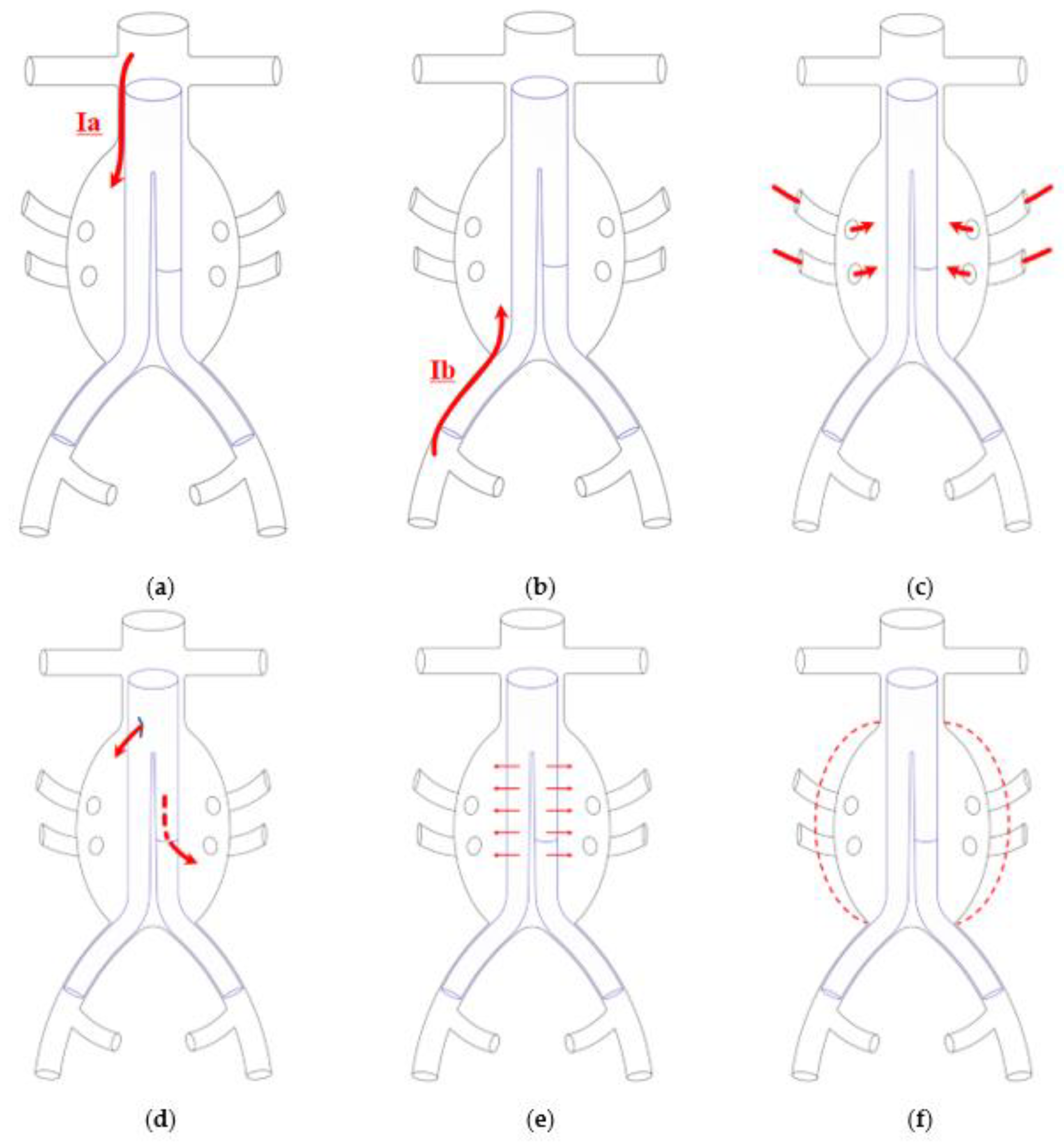 Biomedicines Free FullText Embolization for Type Ia Endoleak after EVAR for Abdominal