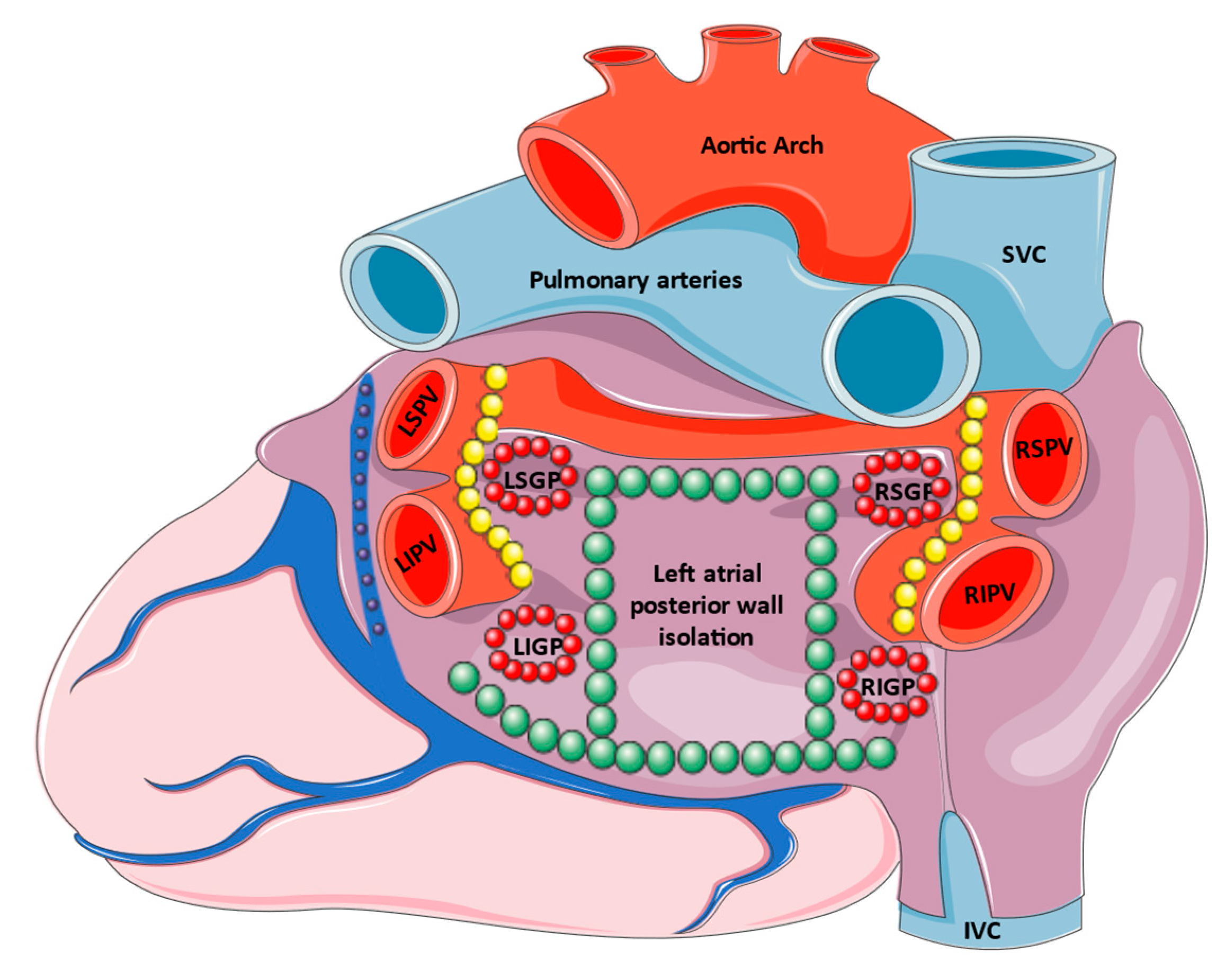 Atrial Fibrillation Ablation