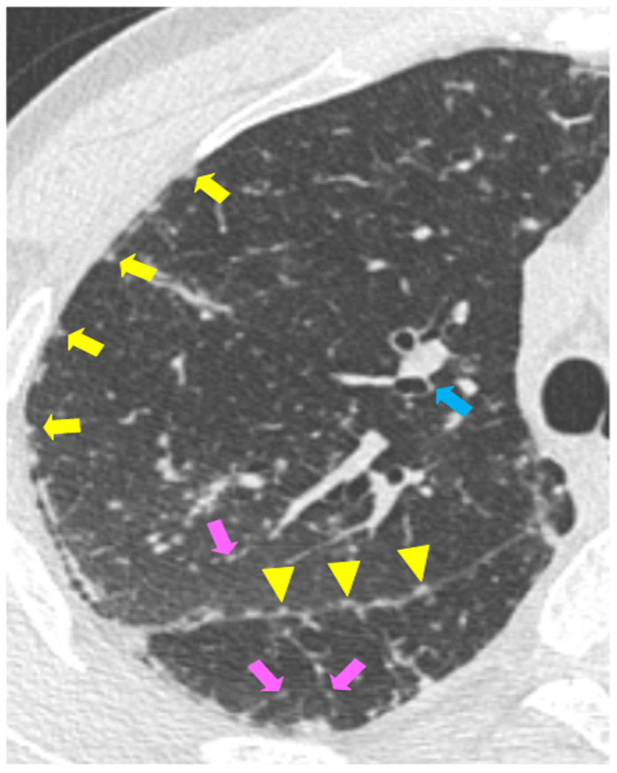 Biomedicines Free FullText Sarcoidosis and COVID19 At the Cross