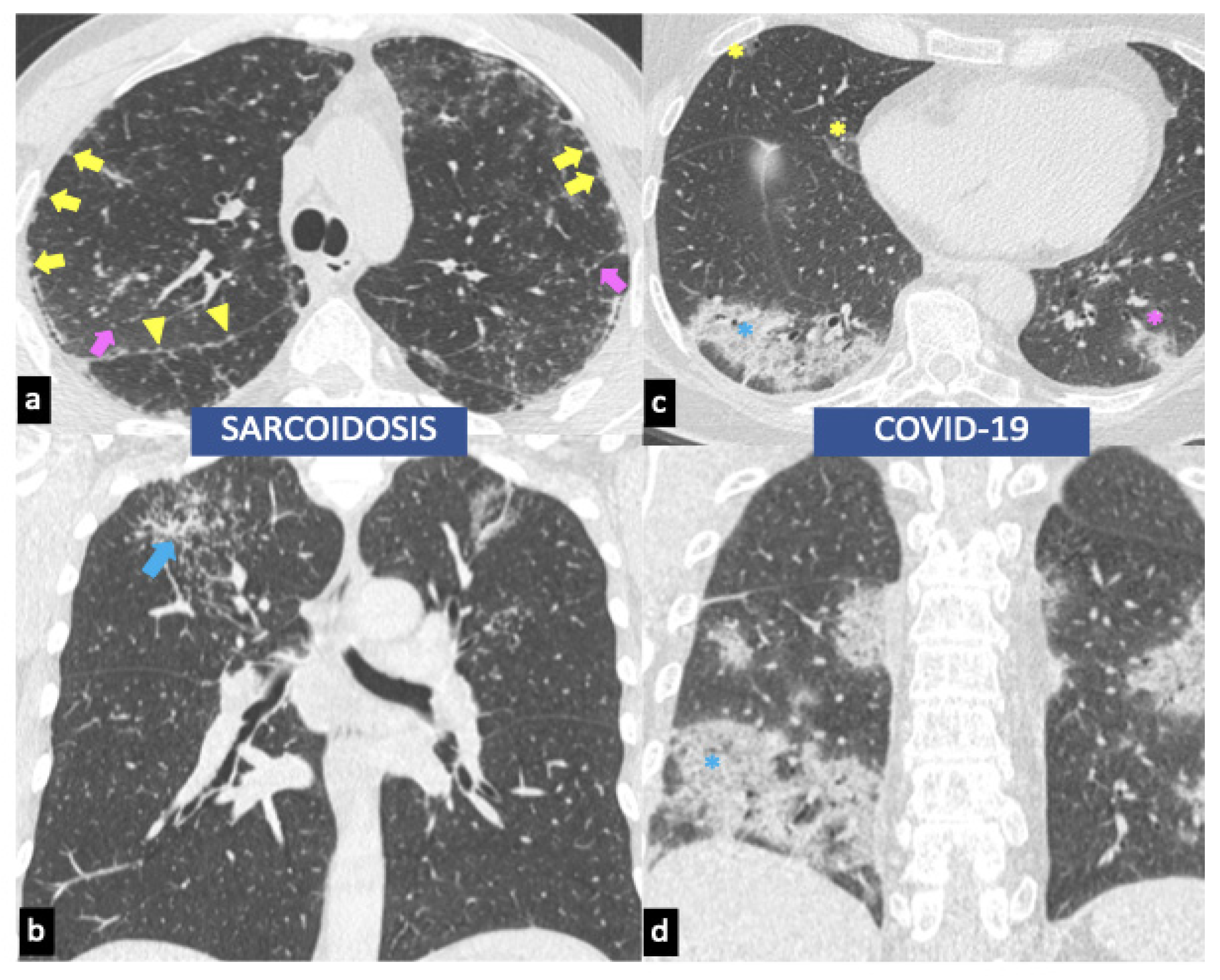 Biomedicines Free FullText Sarcoidosis and COVID19 At the Cross