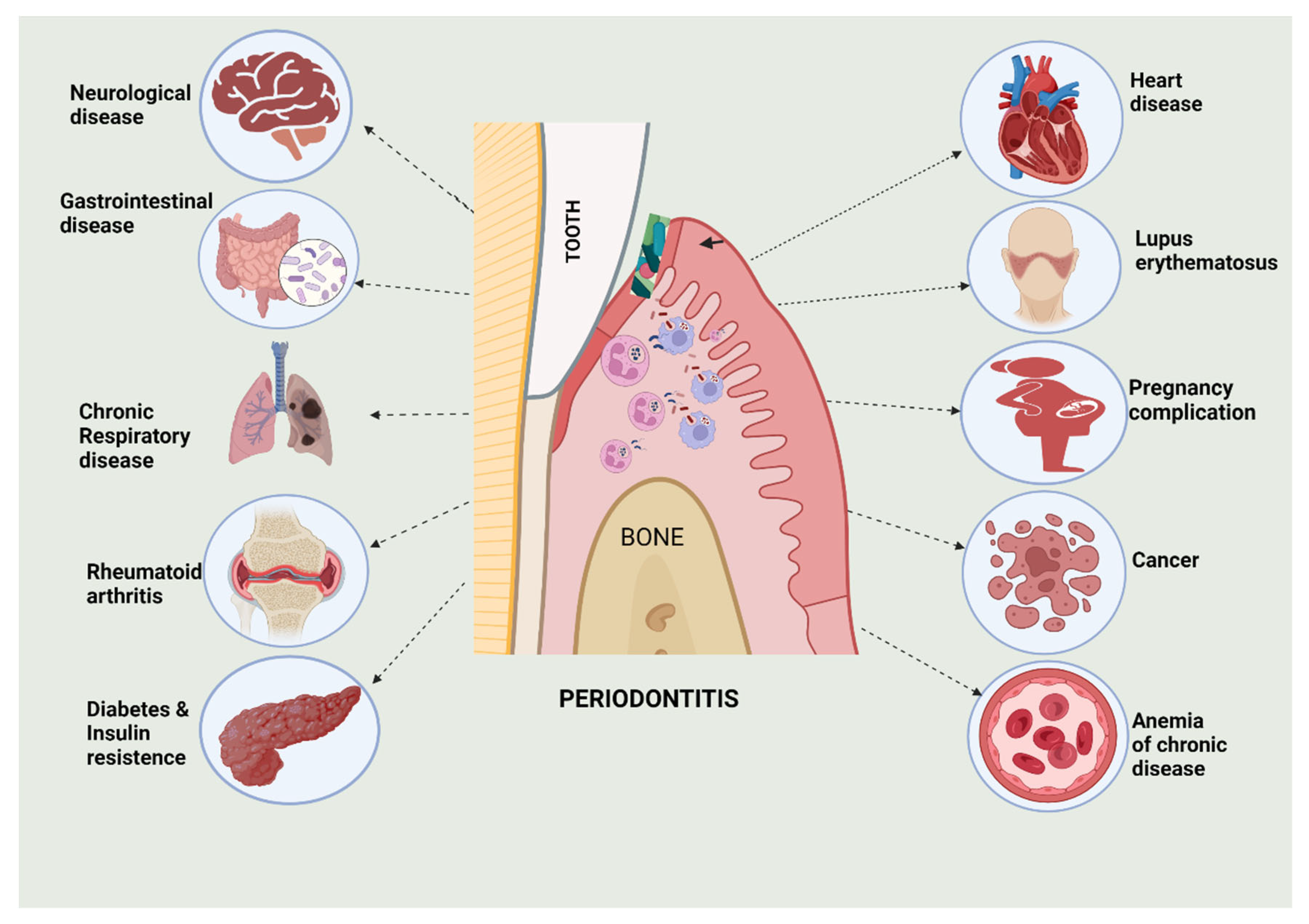 Periodontitis and Its Inflammatory Changes Linked to Various