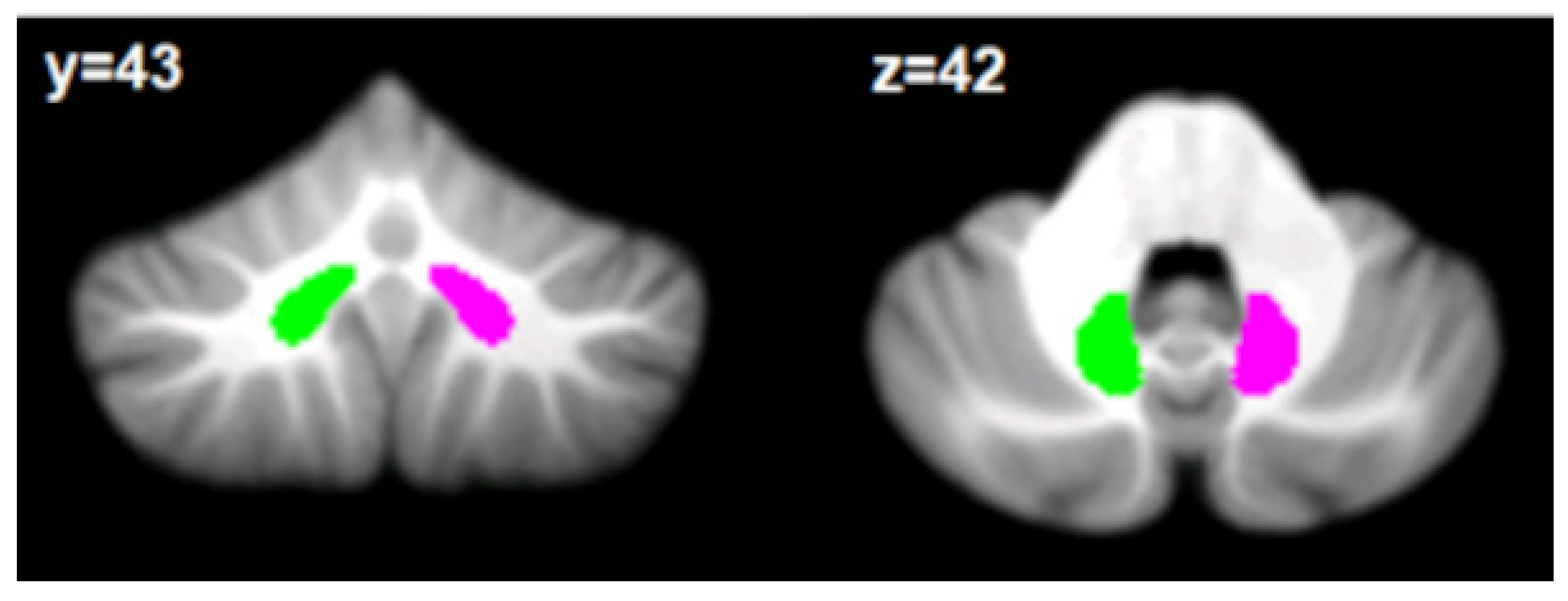 The Cerebellum Is a Key Structure in the Neural Network for