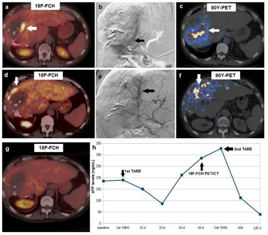 PET/CT with 18F-choline or 18F-FDG in Hepatocellular Carcinoma ...