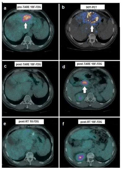 PET/CT with 18F-choline or 18F-FDG in Hepatocellular Carcinoma ...