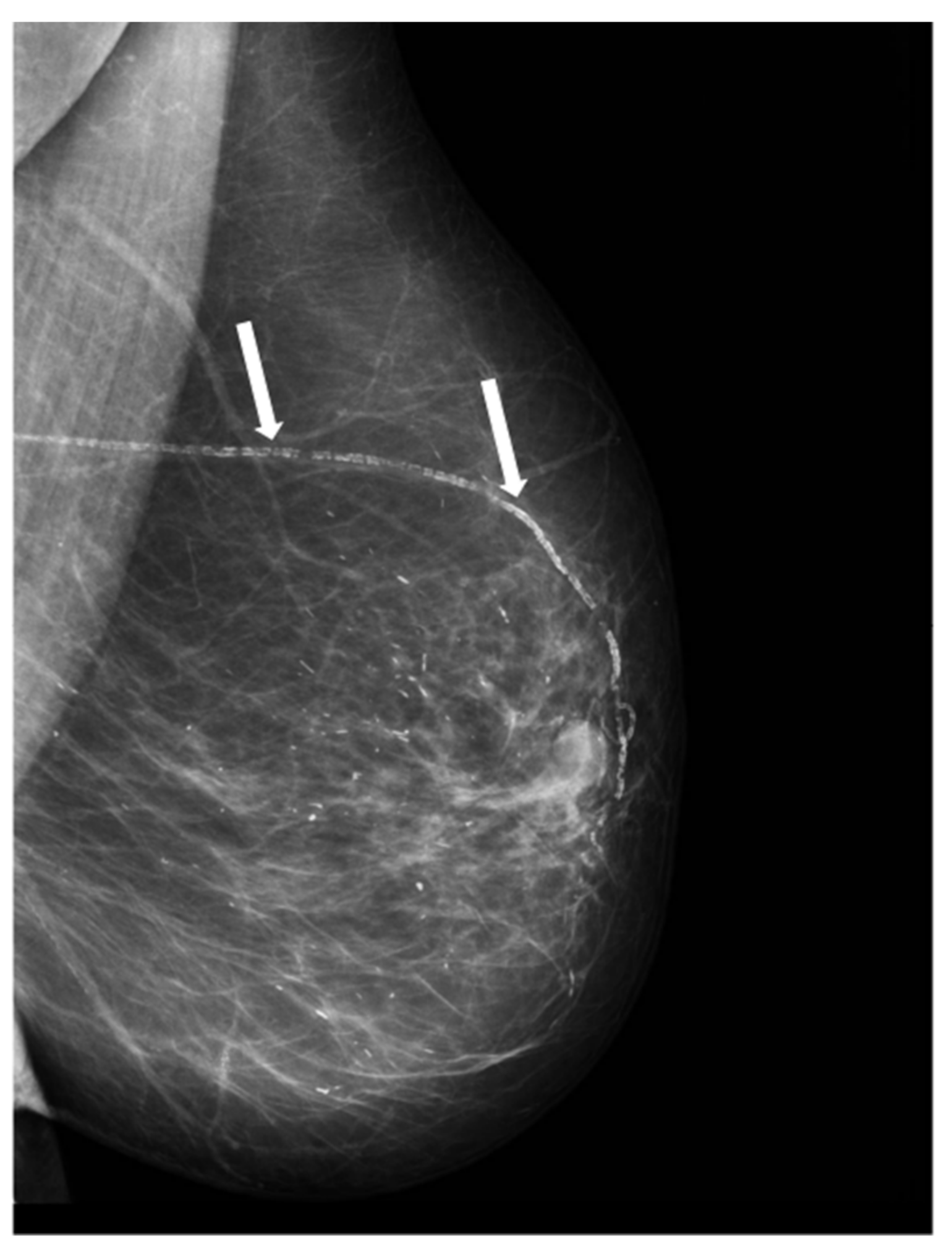 Biomedicines Free Full-Text Relationship between Arterial Calcifications on Mammograms and Cardiovascular Events A Twenty-Three Year Follow-Up Retrospective Cohort Study photo