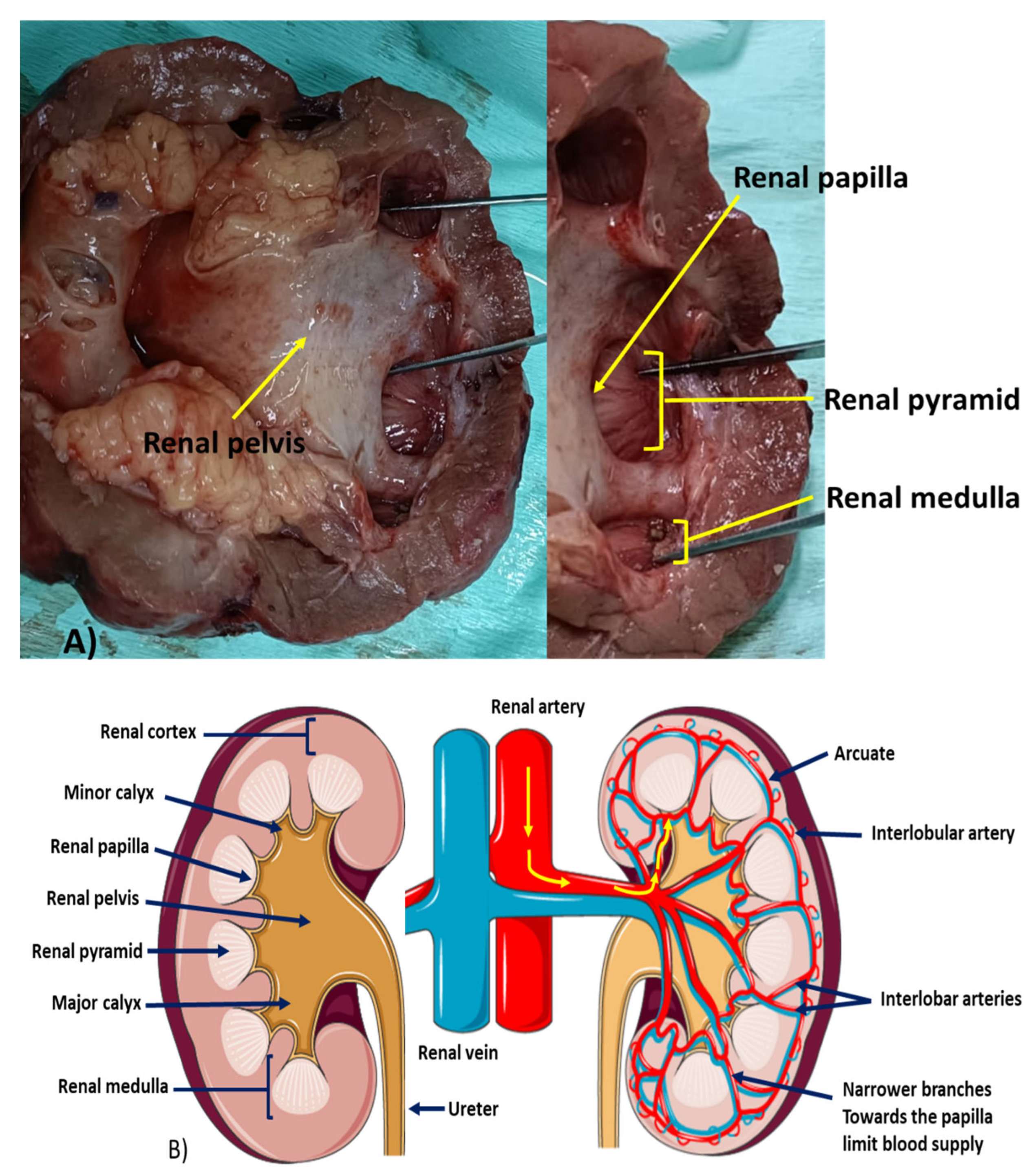 Biomedicines | Free Full-Text | Renal Papillary Necrosis (RPN) in an  African Population: Disease Patterns, Relevant Pathways, and Management