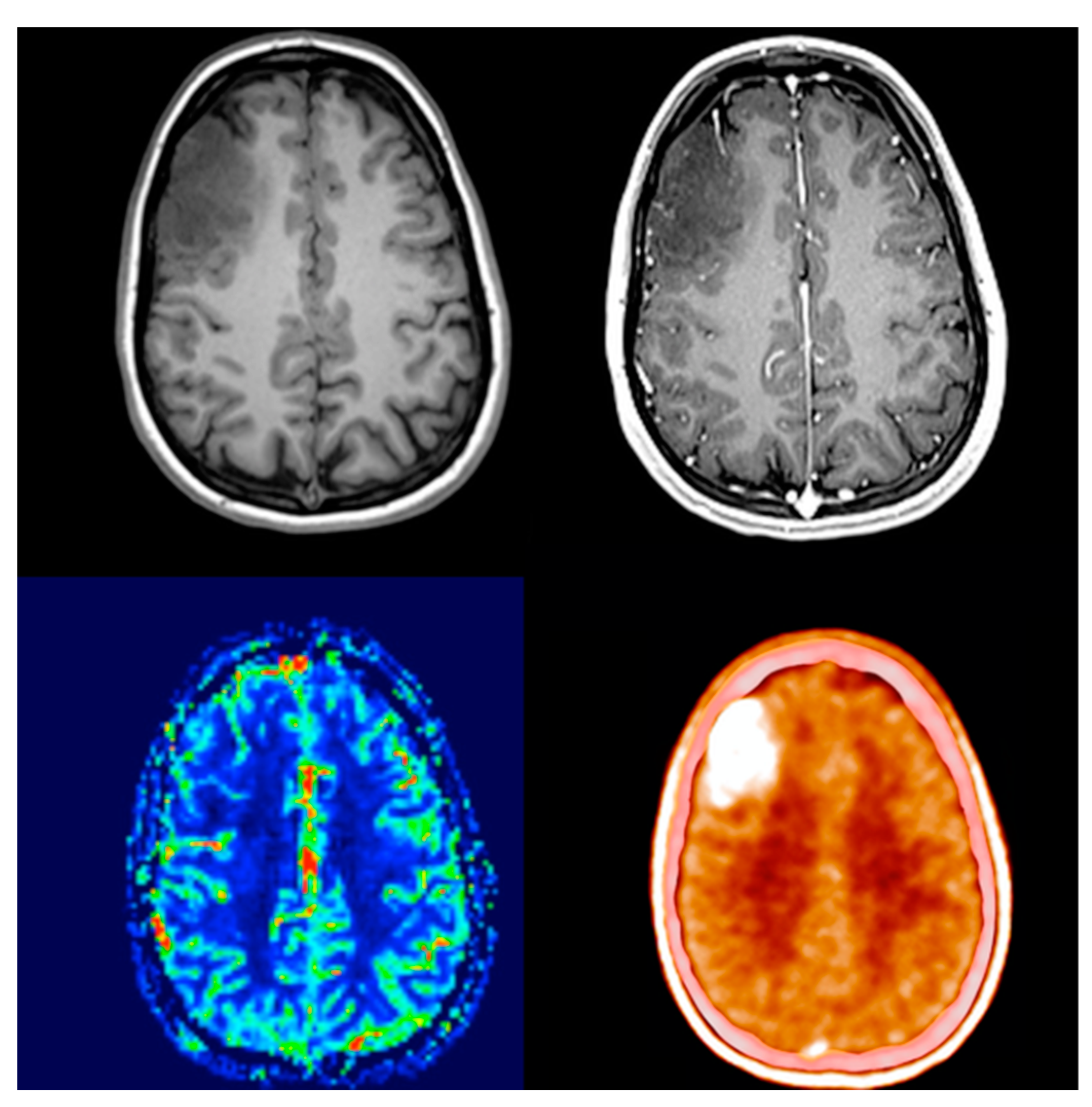 Brain PET scan