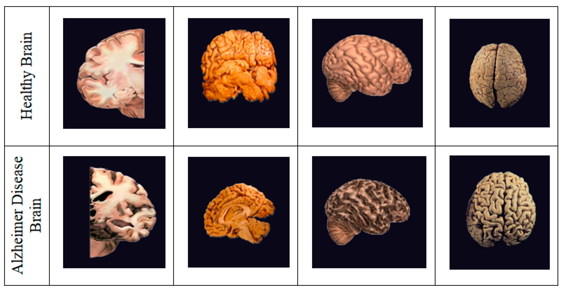 Biomedicines Free FullText Hybridized Deep Learning Approach for Detecting Alzheimer’s Disease