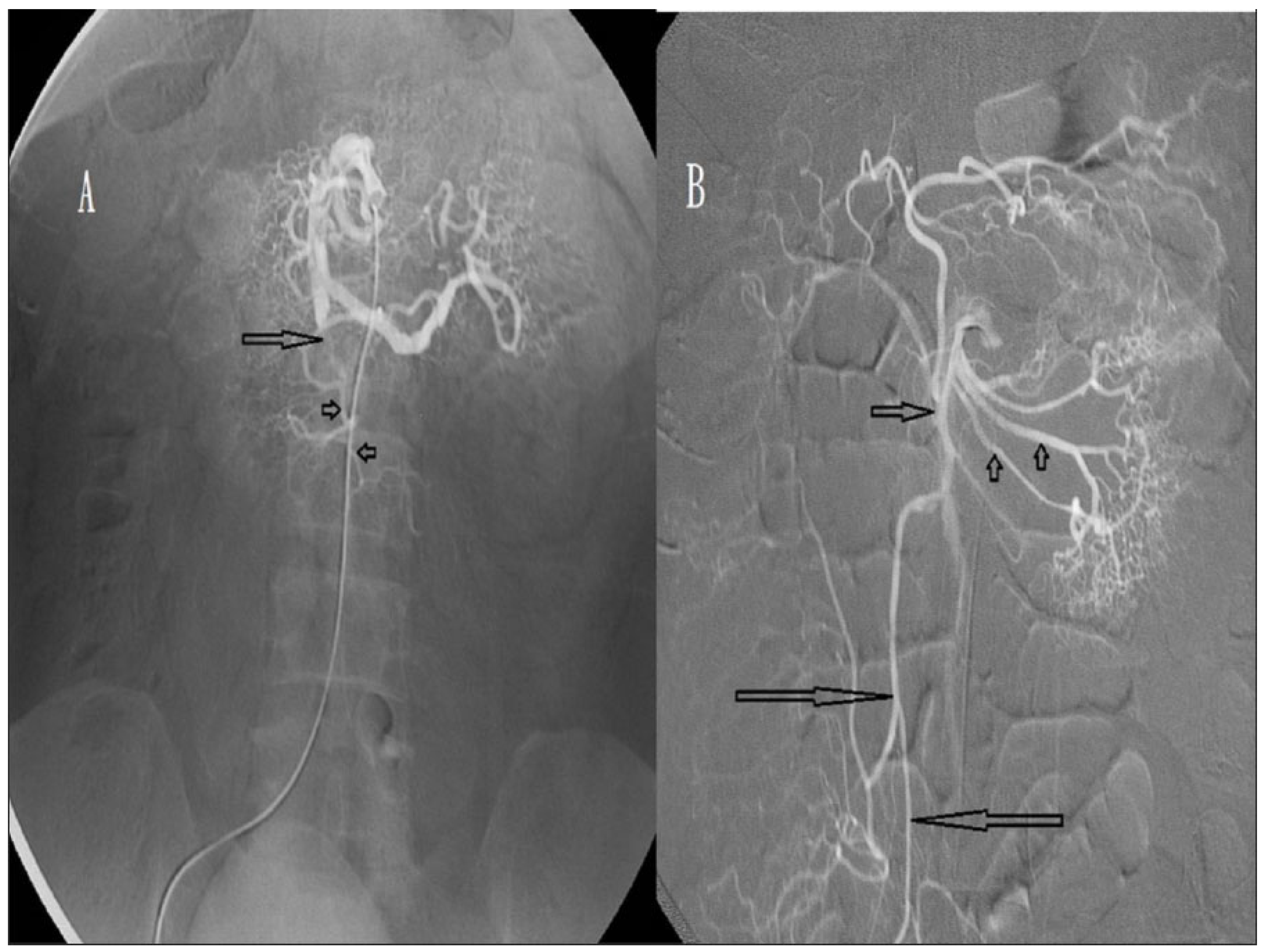 Biomedicines | Free Full-Text | Intra-Arterial Urokinase for Acute