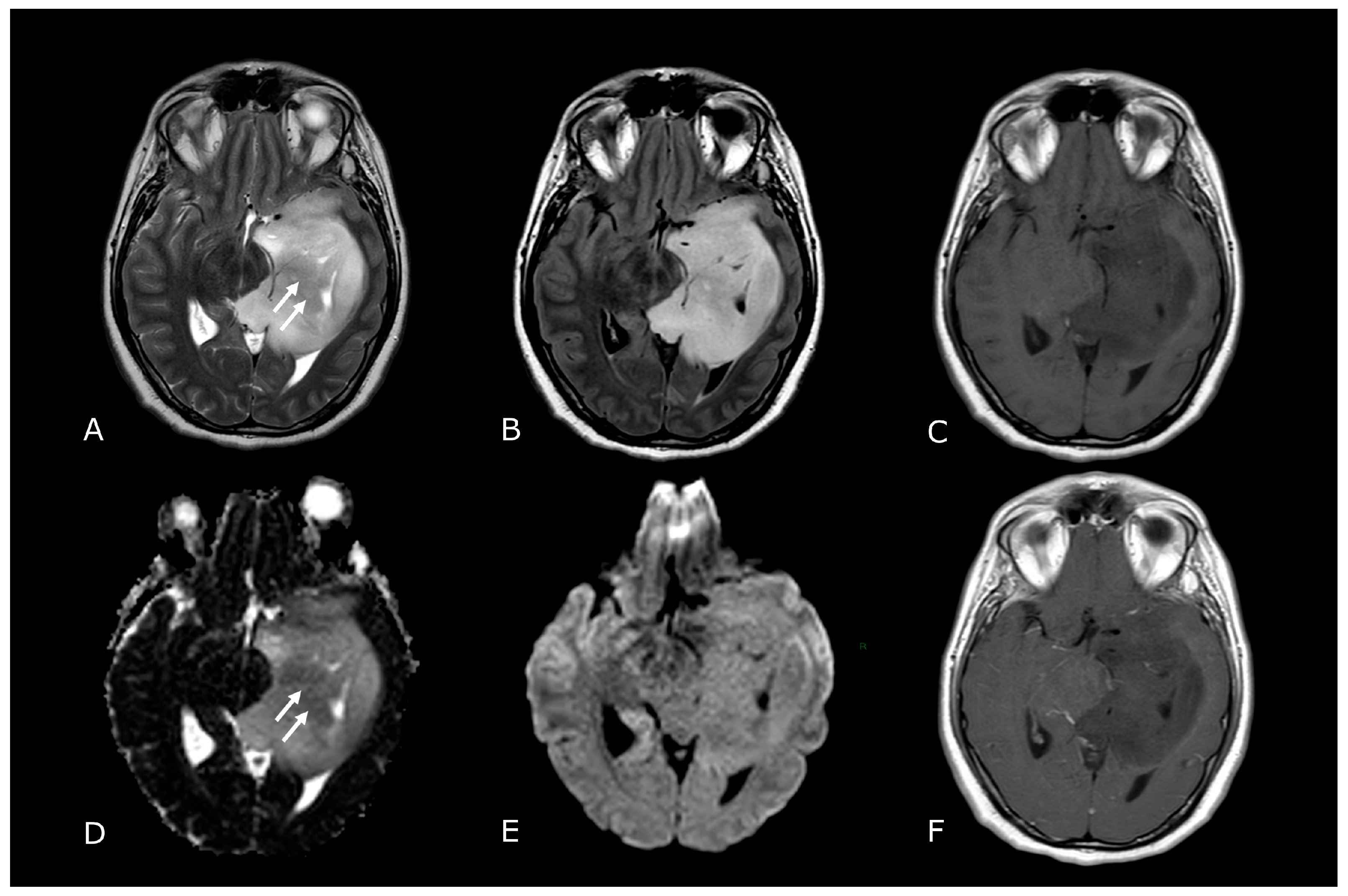 Differential diagnosis of ring enhancing lesions in contrast enhanced CT  and MRI with histopathological corelation: Indian study | Semantic Scholar