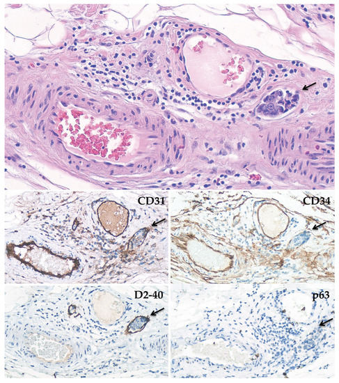 Viscera Infest – Verrucous Carcinoma（帯付） Updates on Lymphovascular Invasion in Breast Cancer