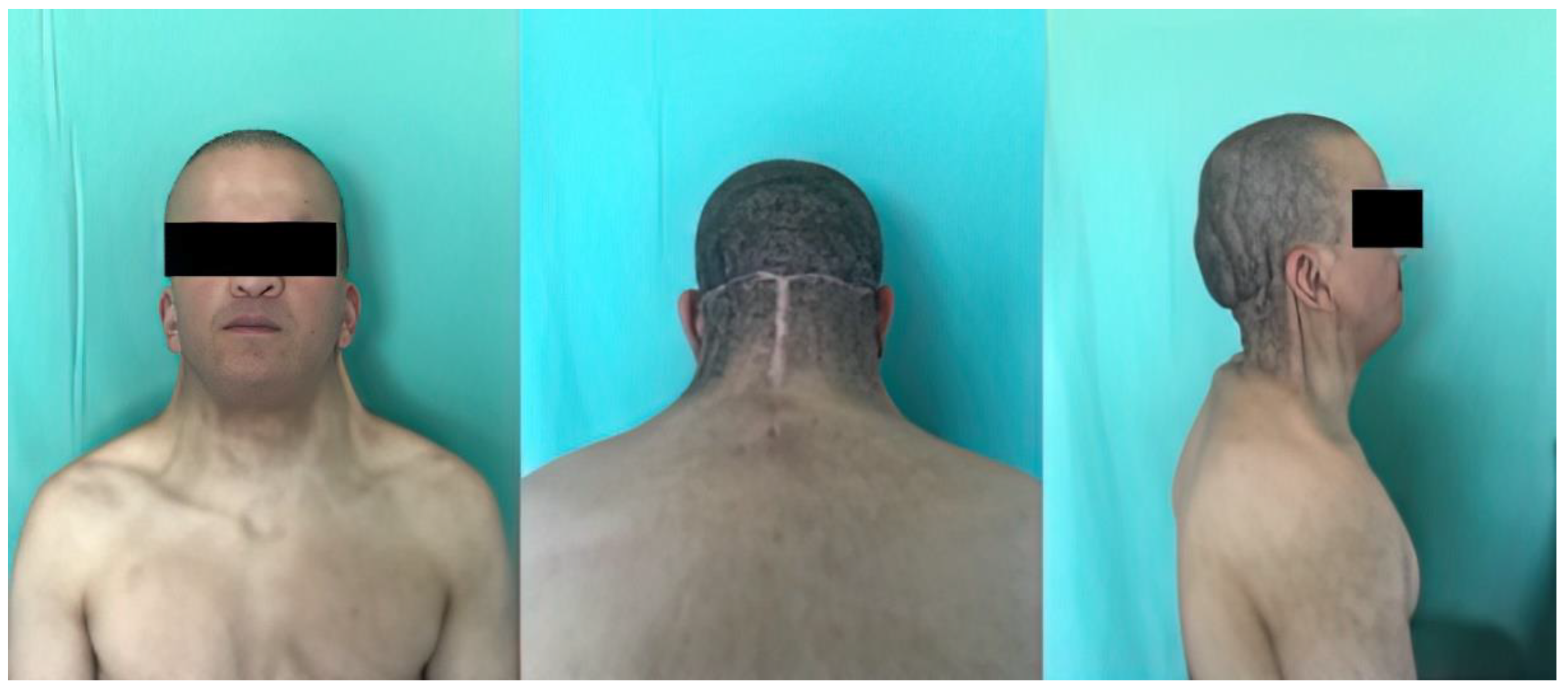 Biomedicines Free FullText Surgical Management of Pterygium Colli