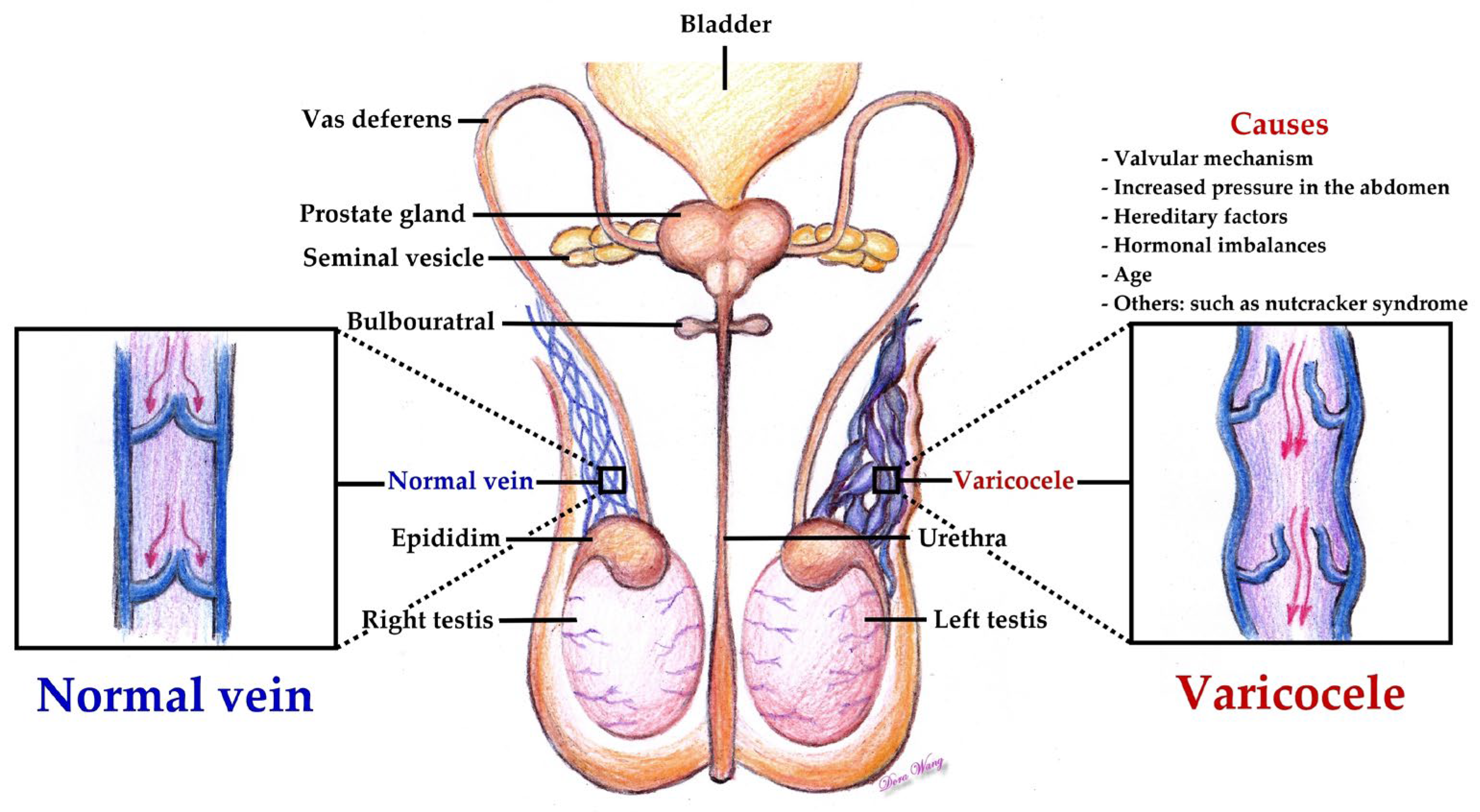 Biomedicines Free Full-Text Scrotal Pain after Varicocelectomy A Narrative Review