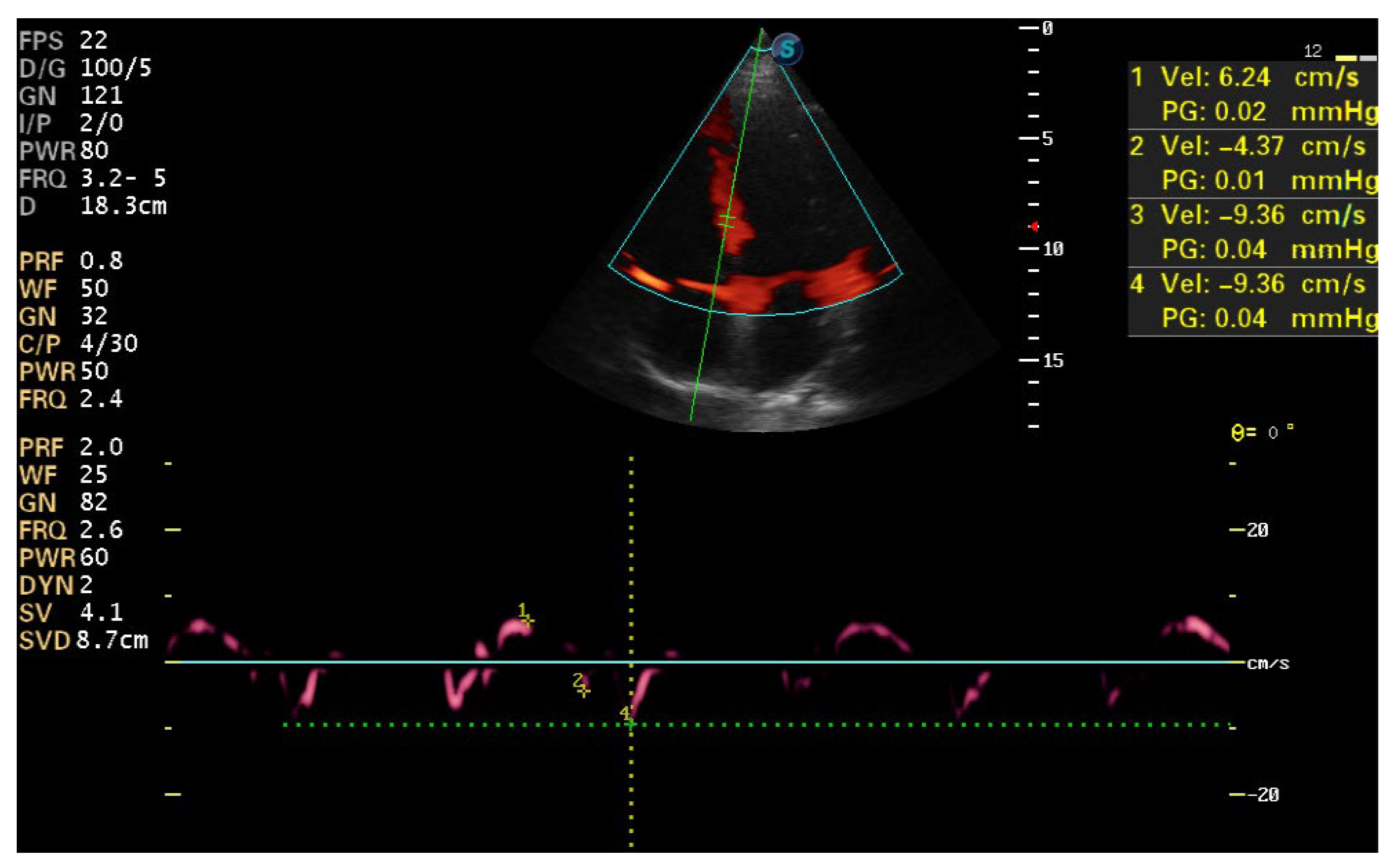 This Simple Test Could Detect Pvc Icd 10 Early - xfw2xbg