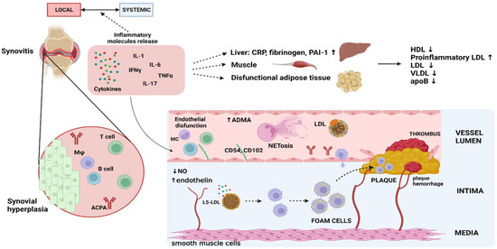 Pathogenesis of Extraarticular Manifestations in Rheumatoid