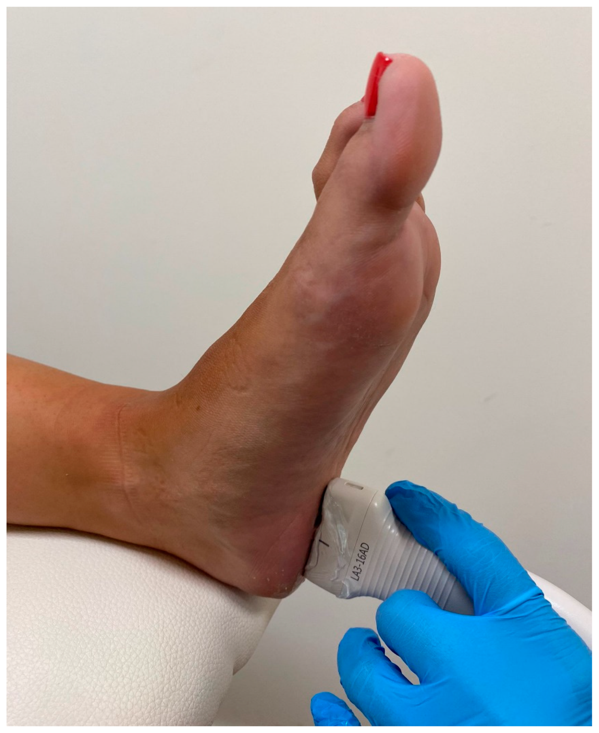 Plantar fascia strain deals