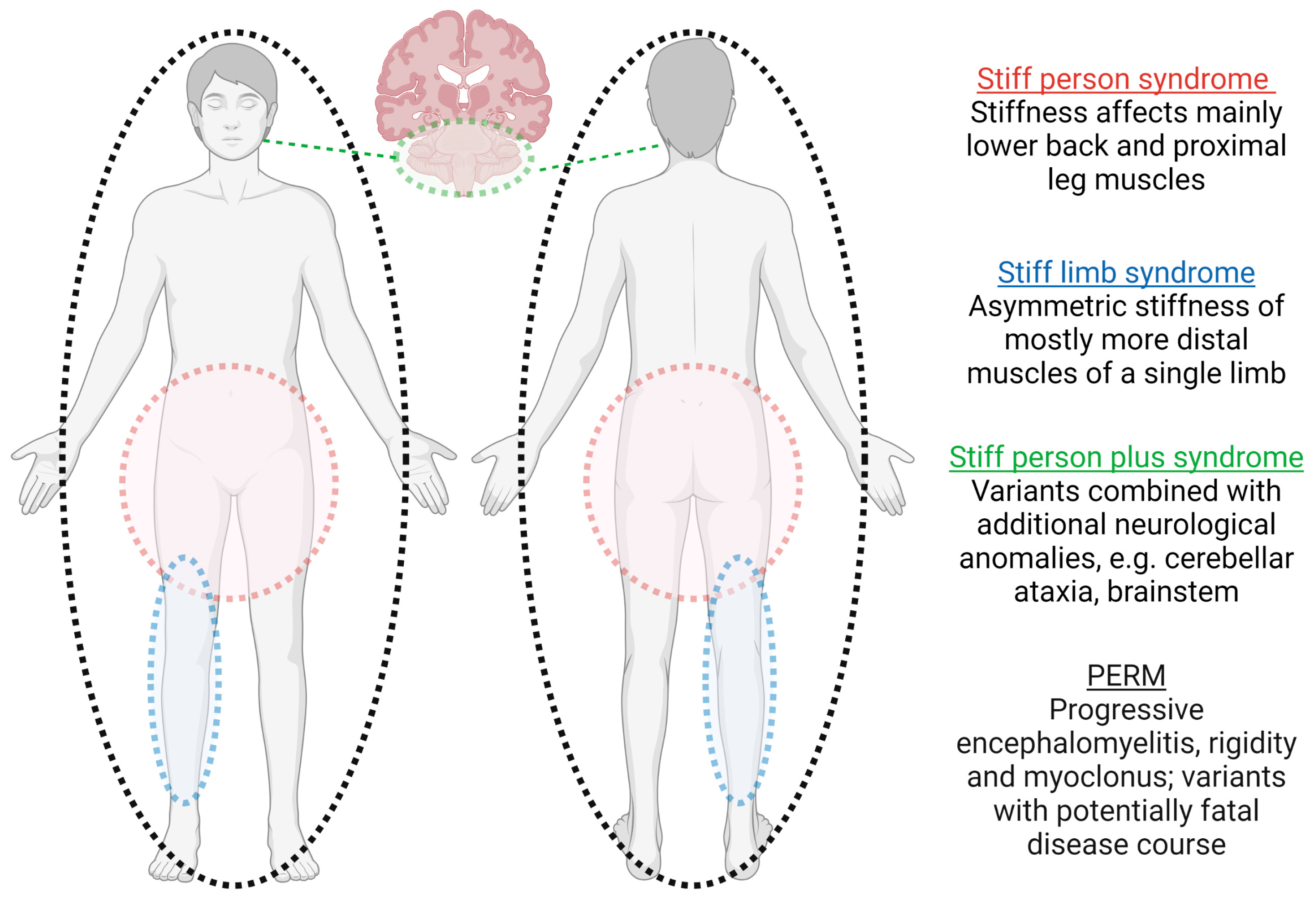 Biomedicines Free Full Text Stiff Person Spectrum Disorders An biomedicines-free-full-text-stiff-person-spectrum-disorders-an