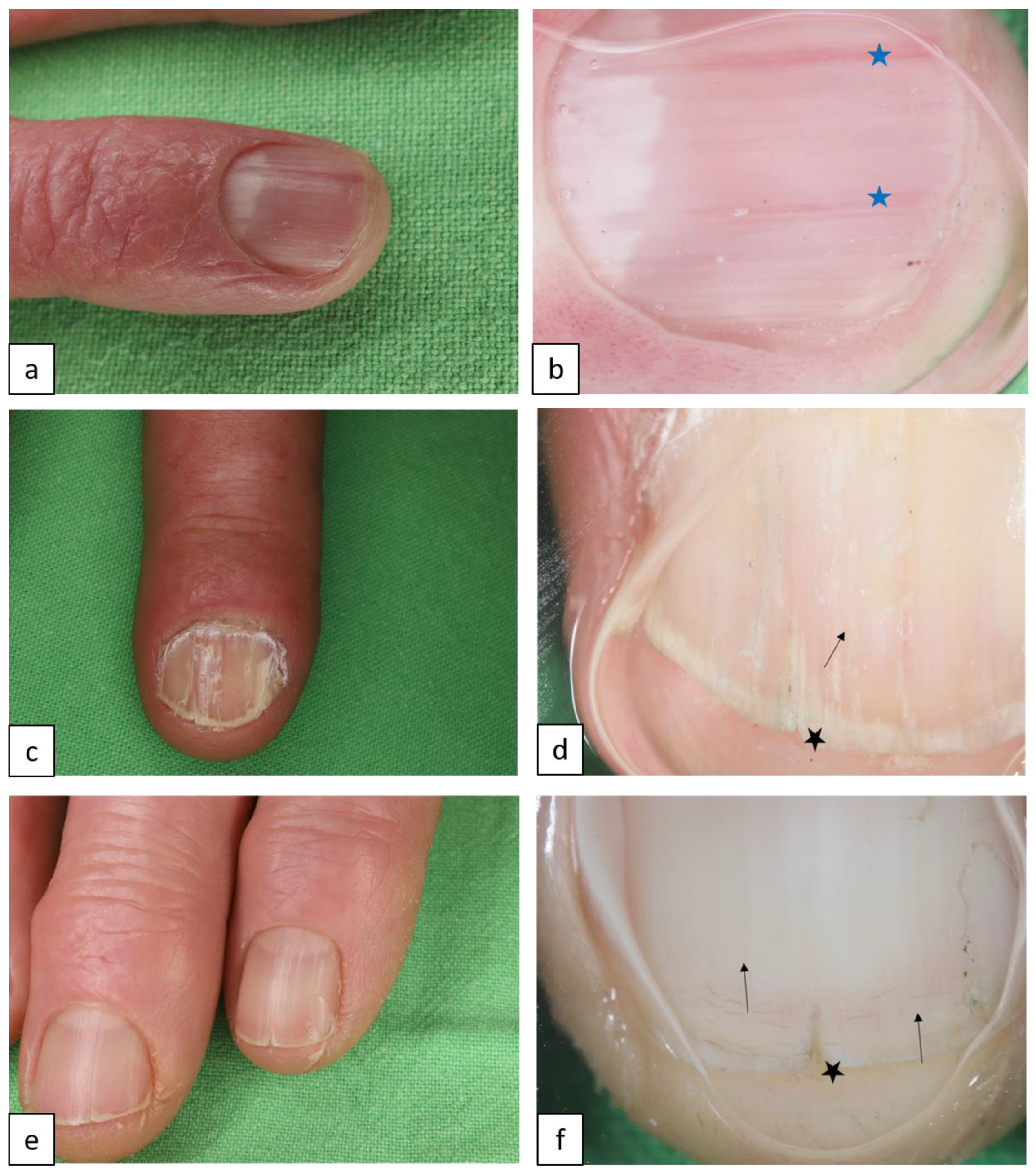 Darier Disease skin and nail findings. (A) Red-brown keratotic... |  Download Scientific Diagram