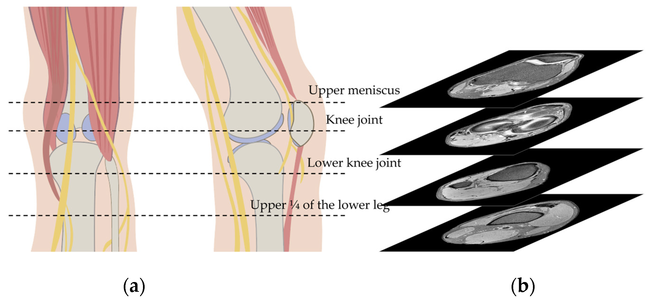 What Is Foot Drop (and What Causes This Peroneal Nerve Injury)?